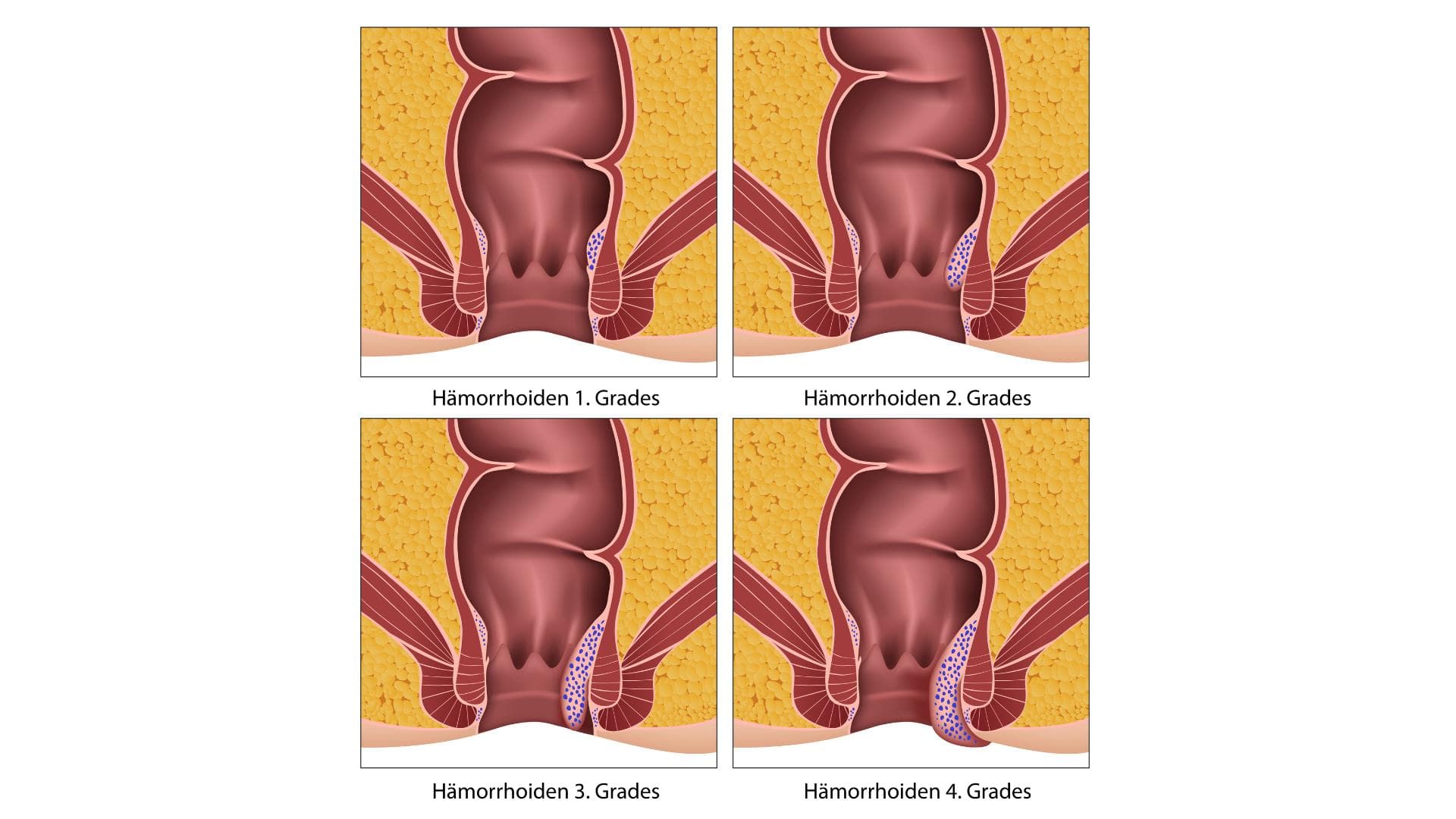 Hämorrhoiden Grafik
