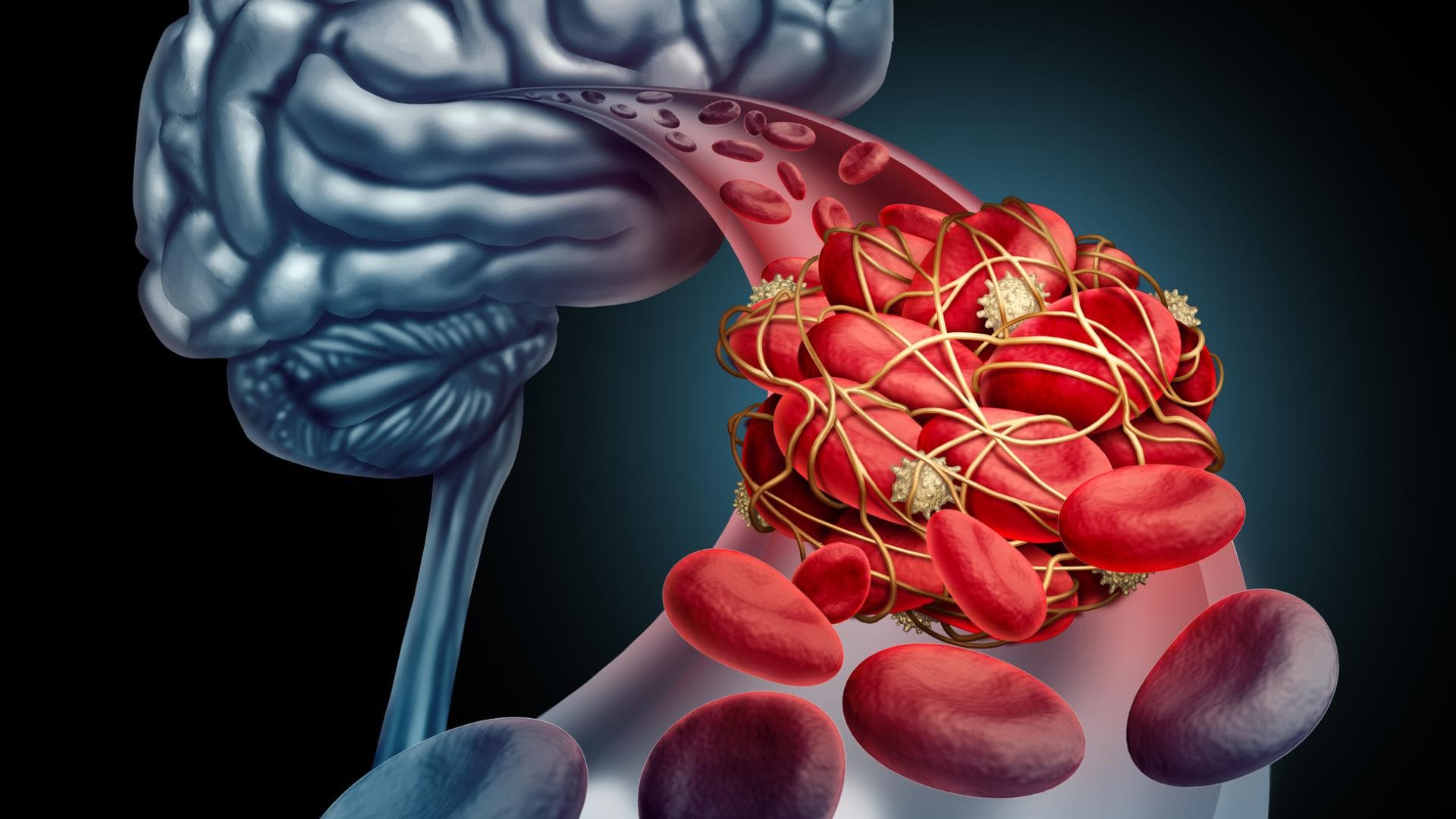 Hirnvenenthrombose