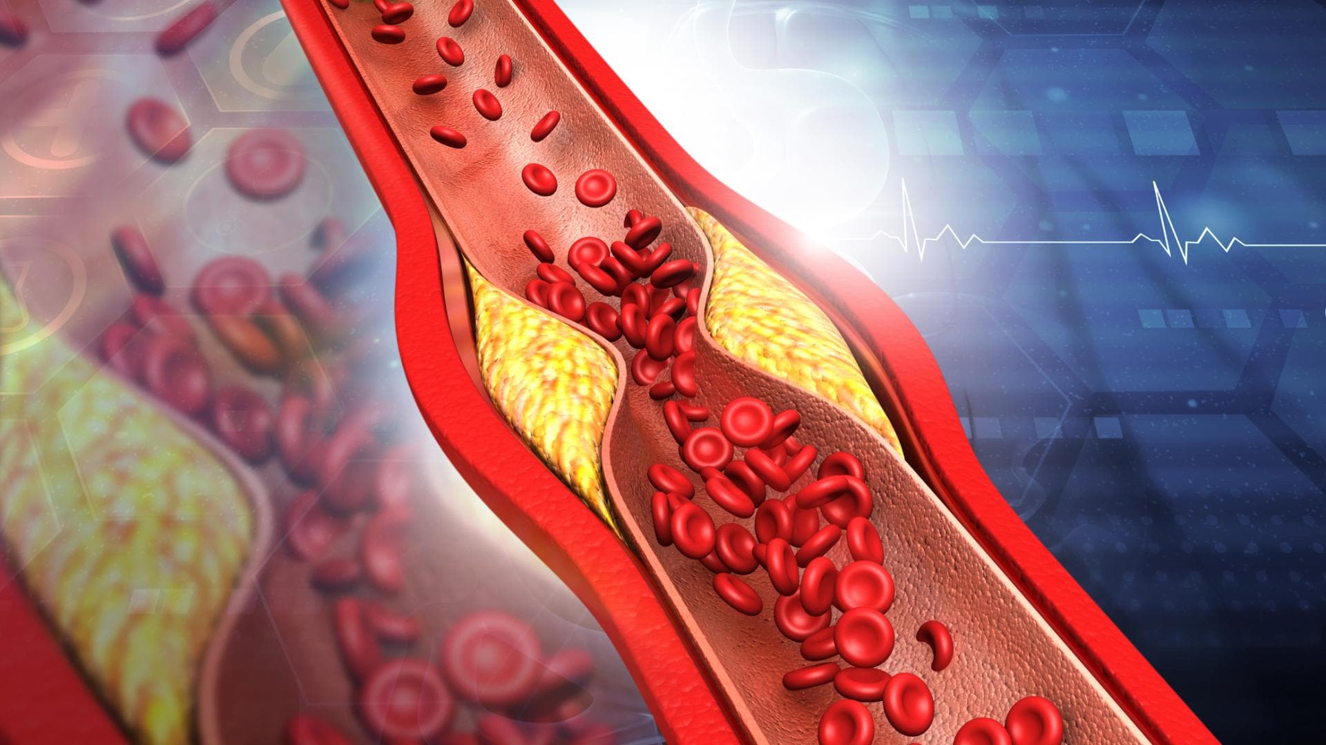  Hohe LDL-Cholesterinspiegel können zu einer Anhäufung von Cholesterin in den Arterien führen