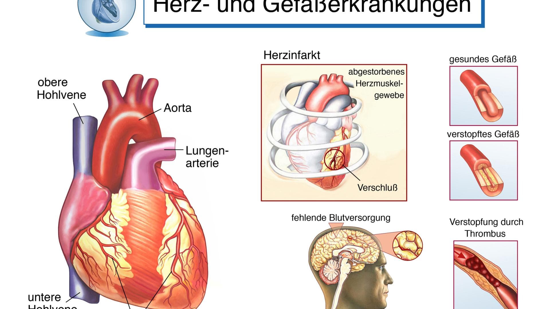 Infografik zu Herz- und Gefäßerkrankungen
