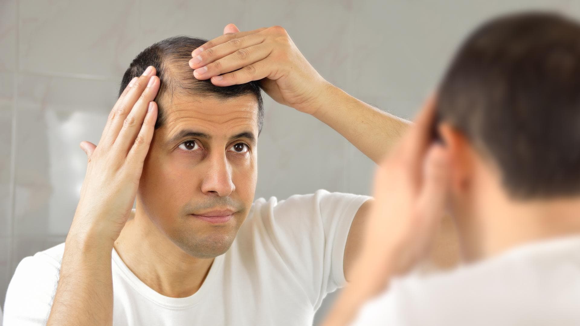 Mann mit Haarausfall