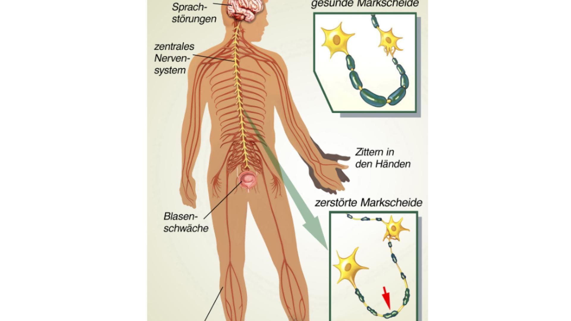 Grafische Darstellung der Krankheit Multiple Sklerose