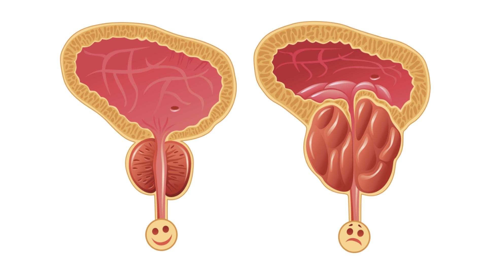 Grafik einer gesunden Prostata und einer vergrößerten Prostata