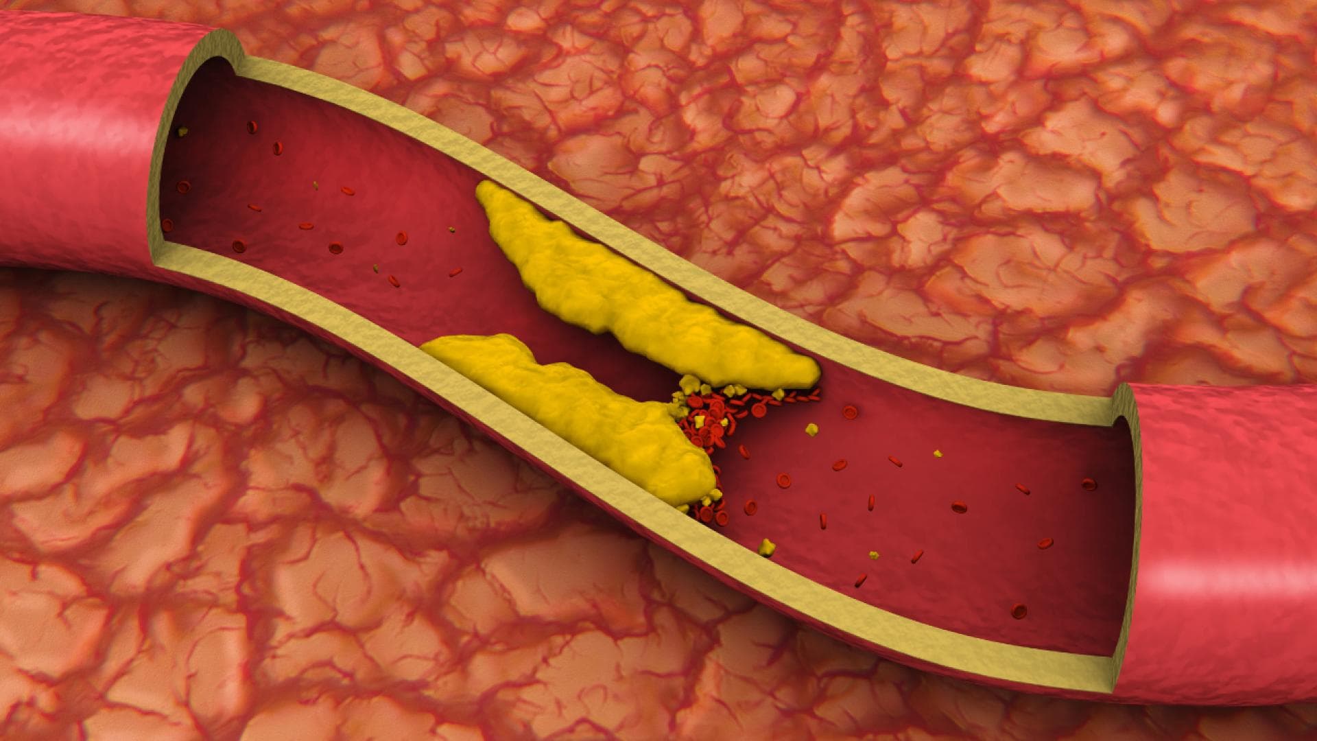 Verstopfte Arterie