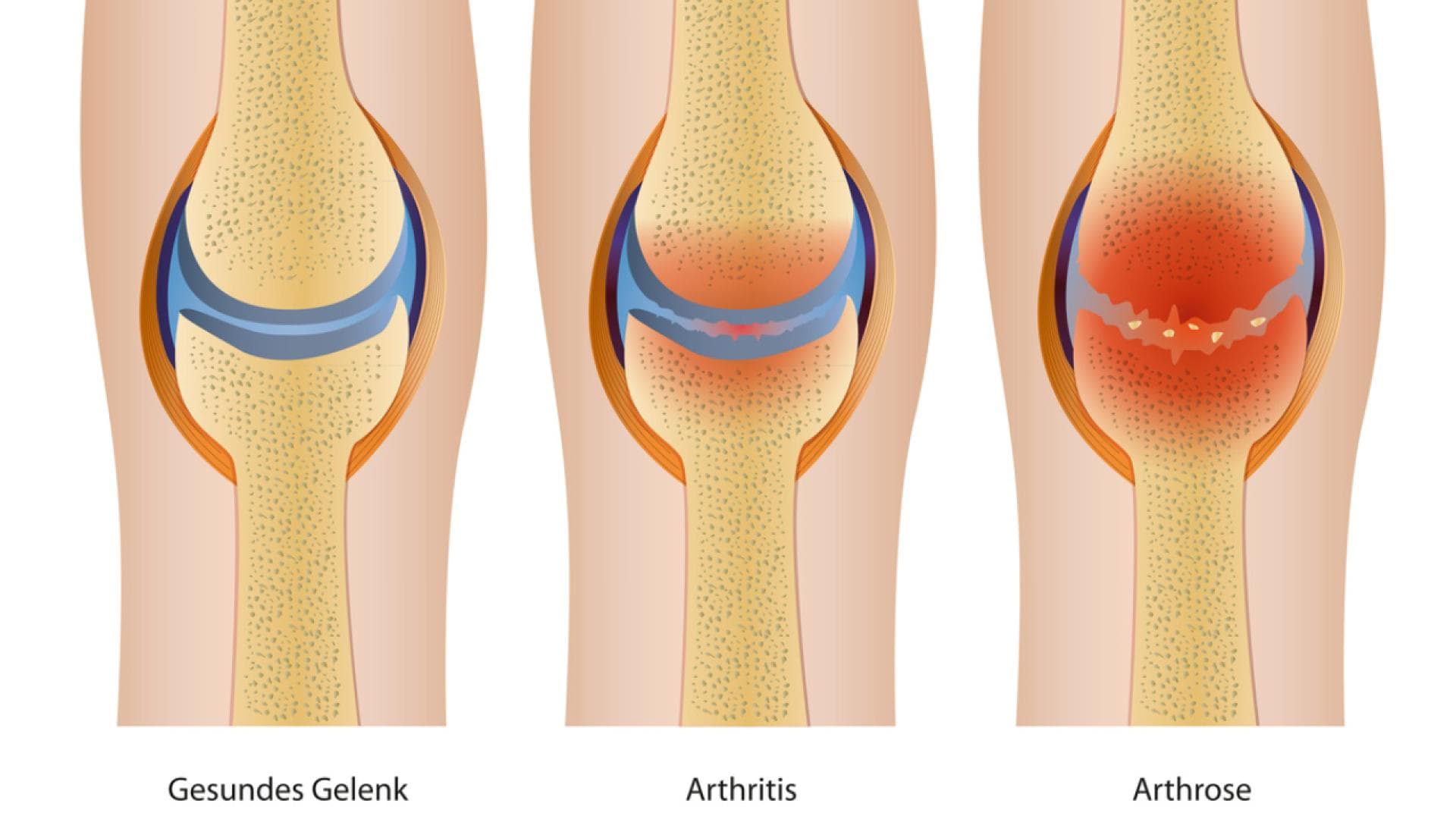 Grafische Darstellung von Arthritis und Arthrose