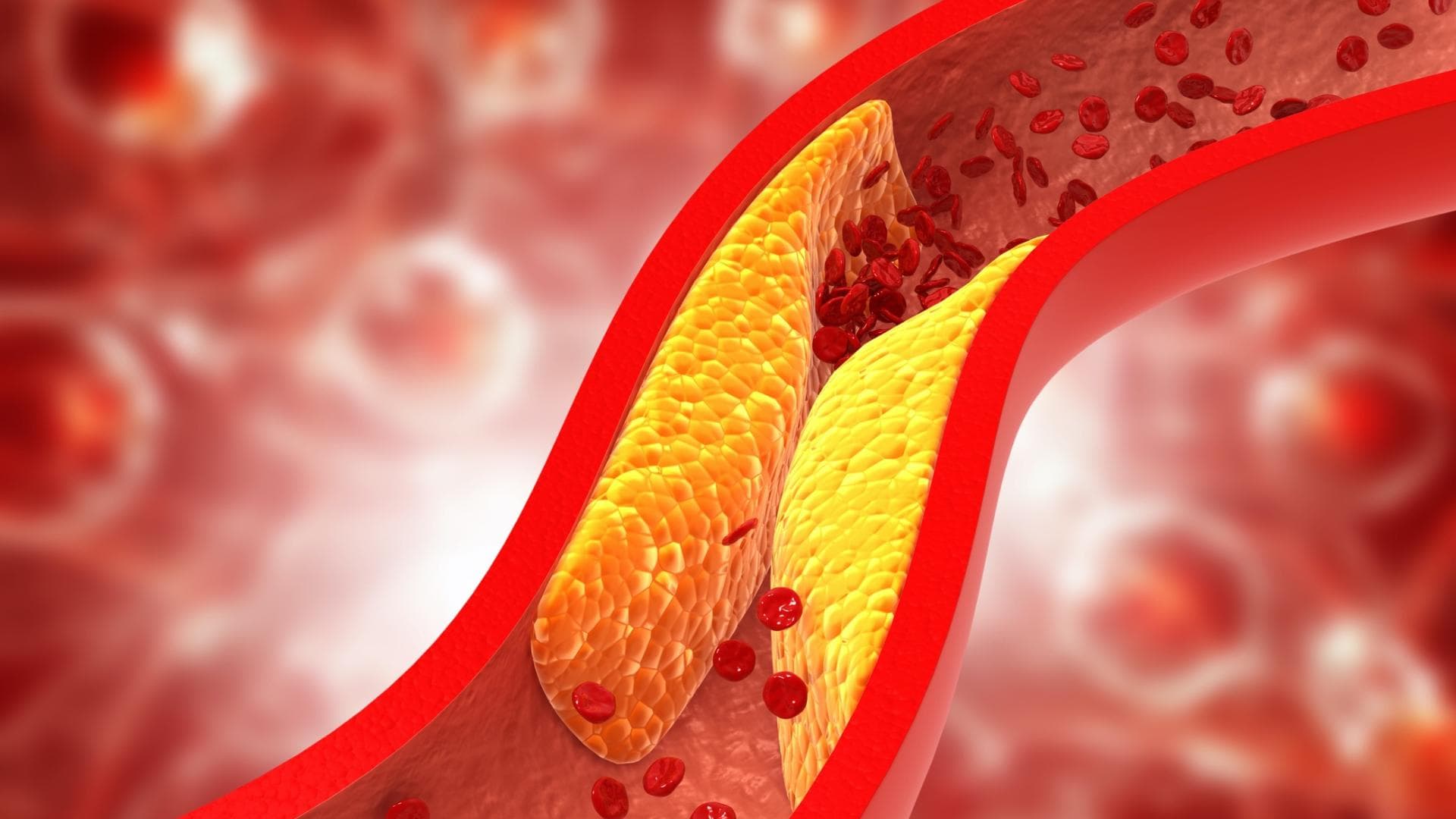 Verstopfte Arterien