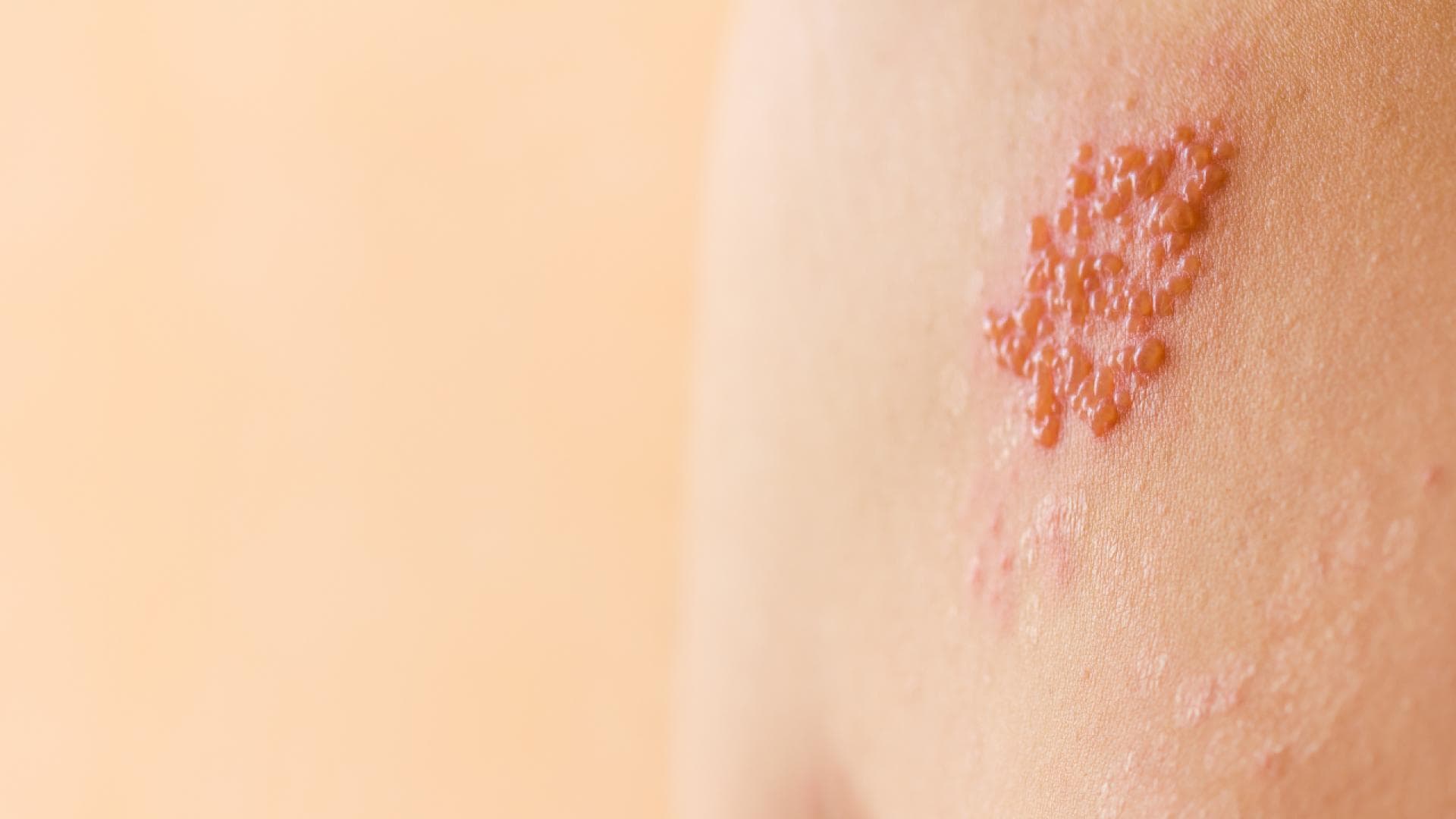 Starke Belastungen können das Immunsystem schwächen und zu Gürtelrose führen. Starke Belastungen können das Immunsystem schwächen und zu Gürtelrose führen.