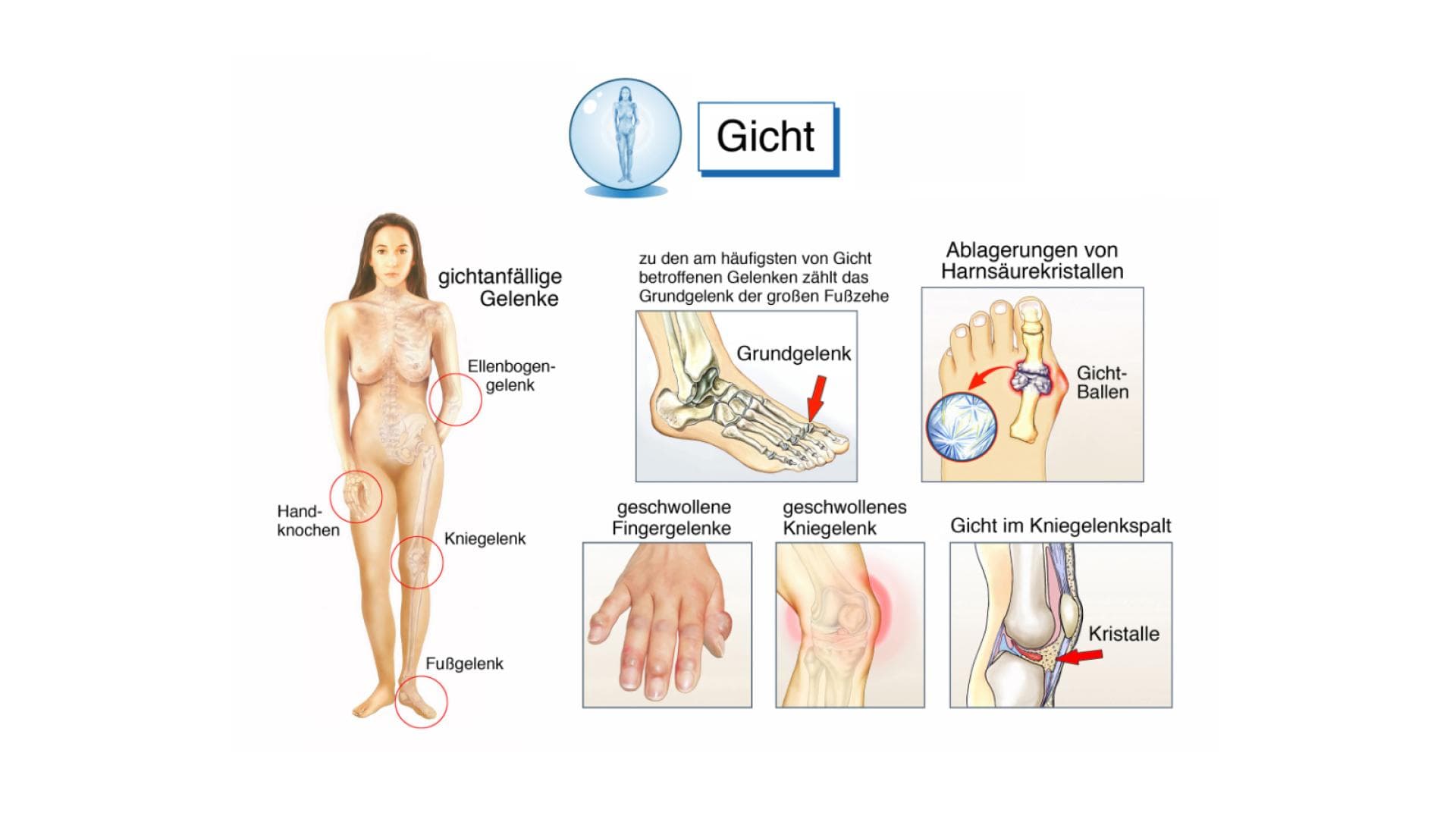 Infografik zur Gicht
