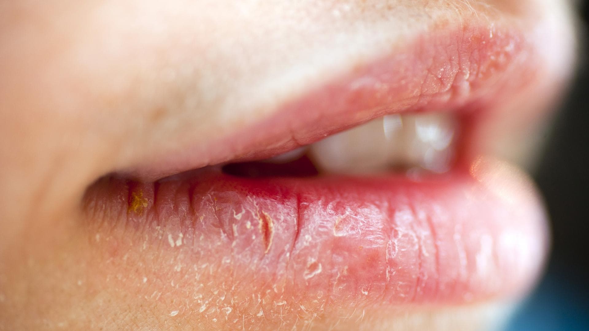 Wunde Lippen