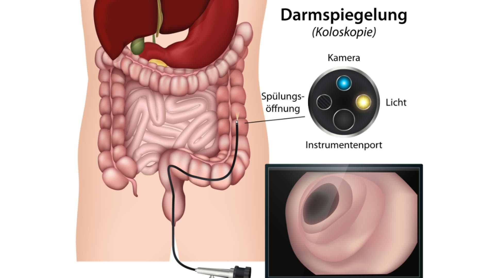Grafische Darstellung einer Darmspiegelung