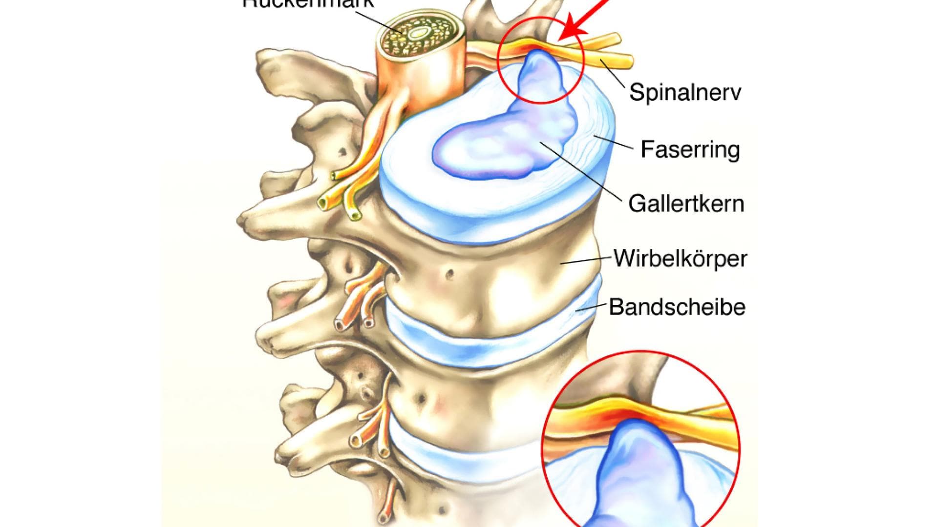 Grafische Darstellung eines Bandscheibenvorfalls