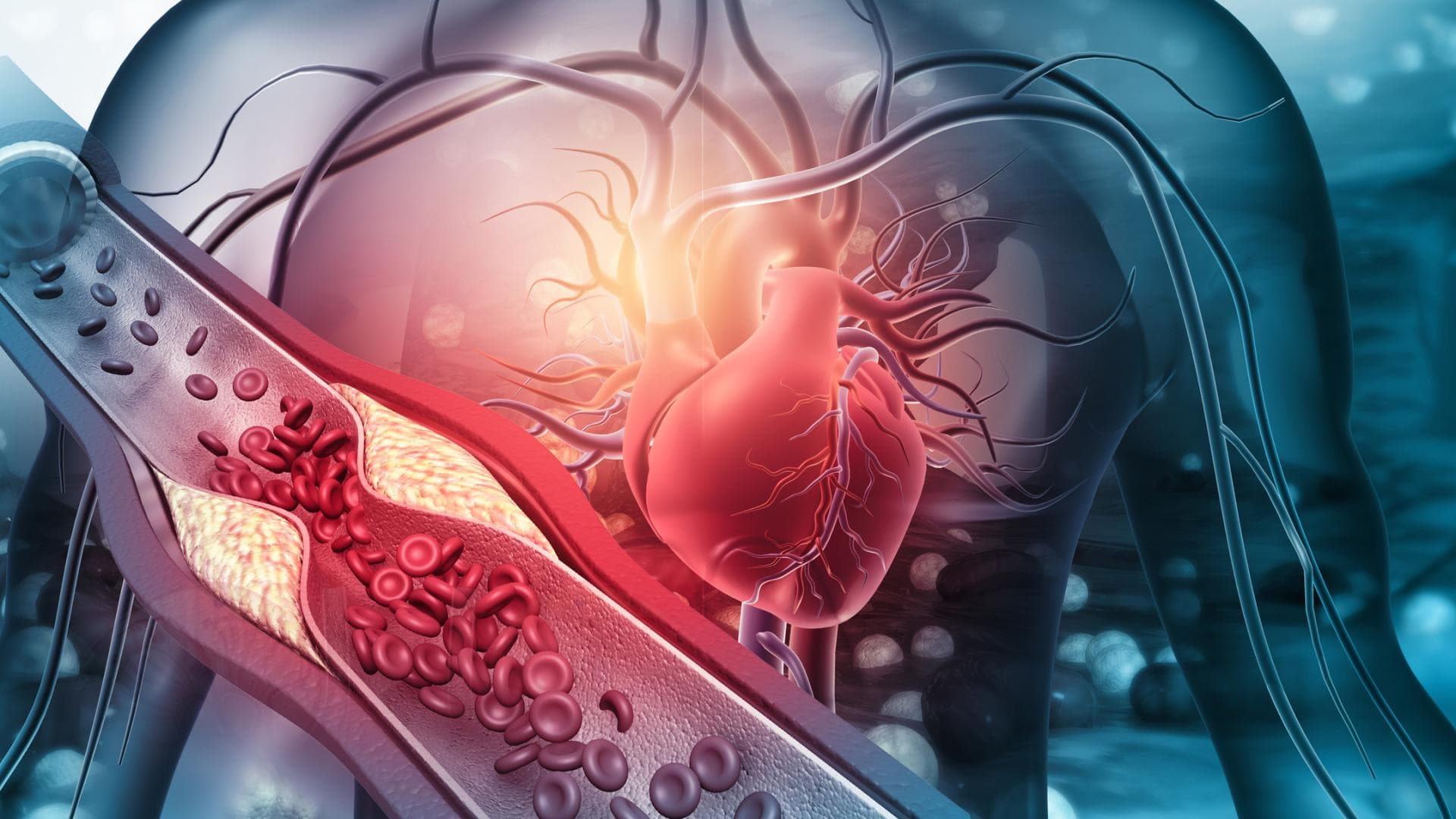 Herz verstopfte Arterien Herz verstopfte Arterien