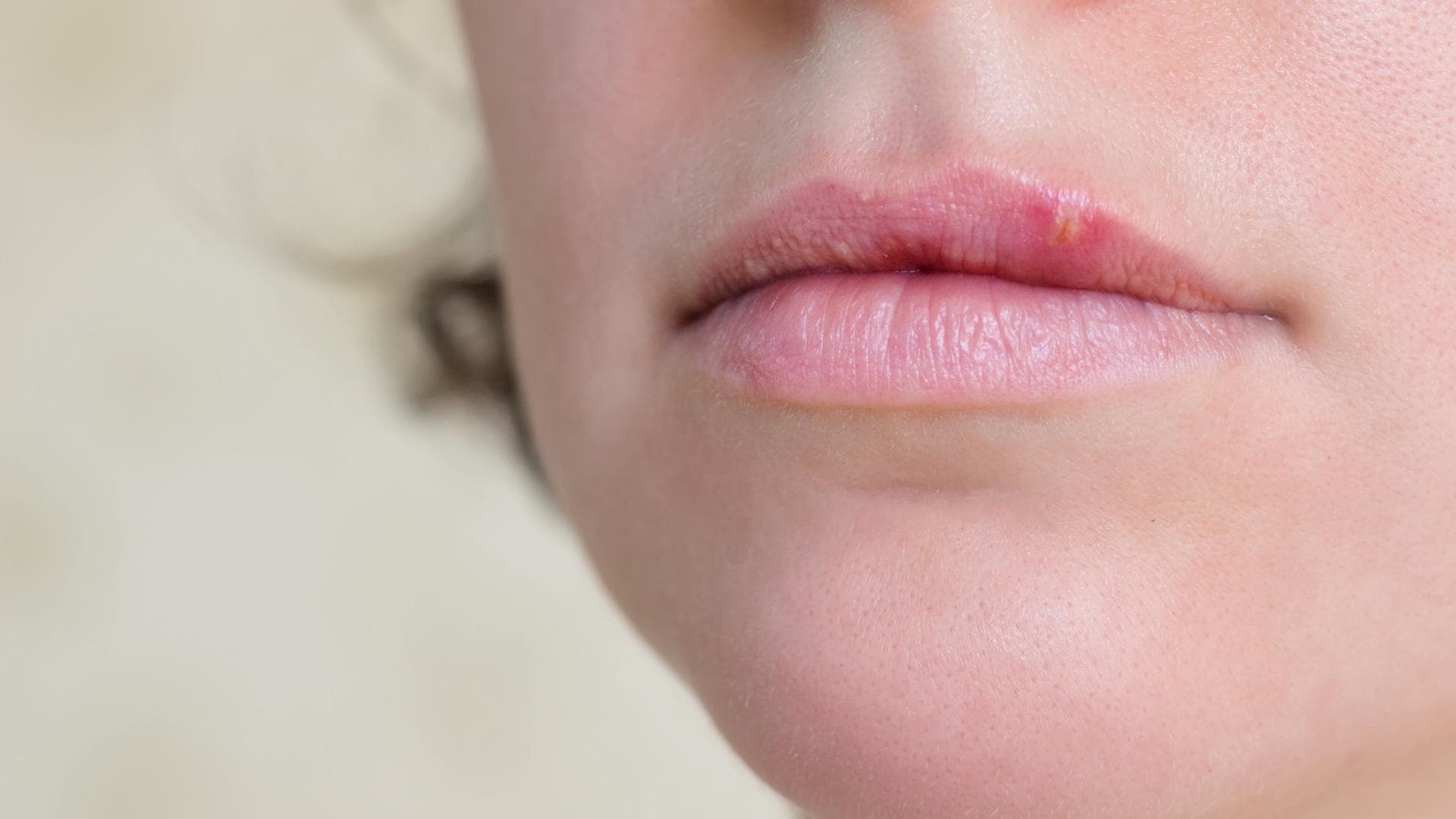 Frau mit Lippenherpes