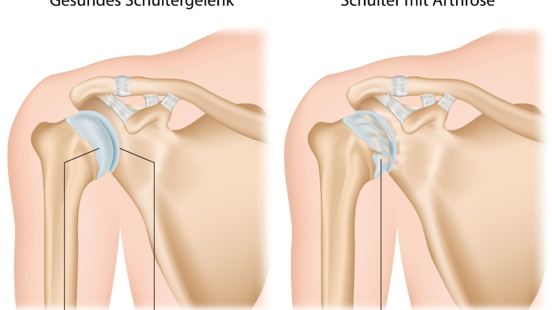 Grafische Darstellung einer Schulterarthrose