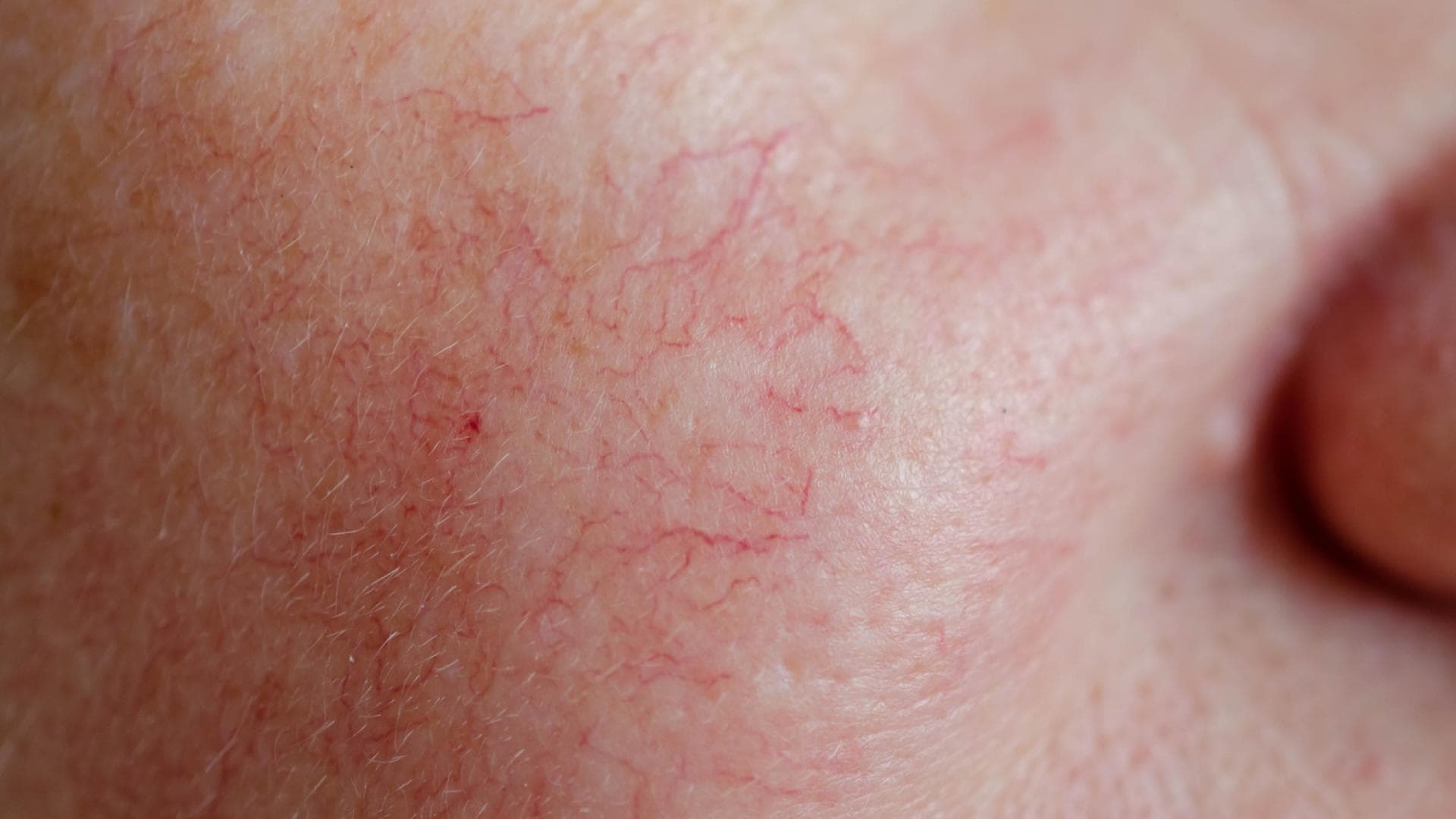 Nahaufnahme rote Äderchen auf Wange
