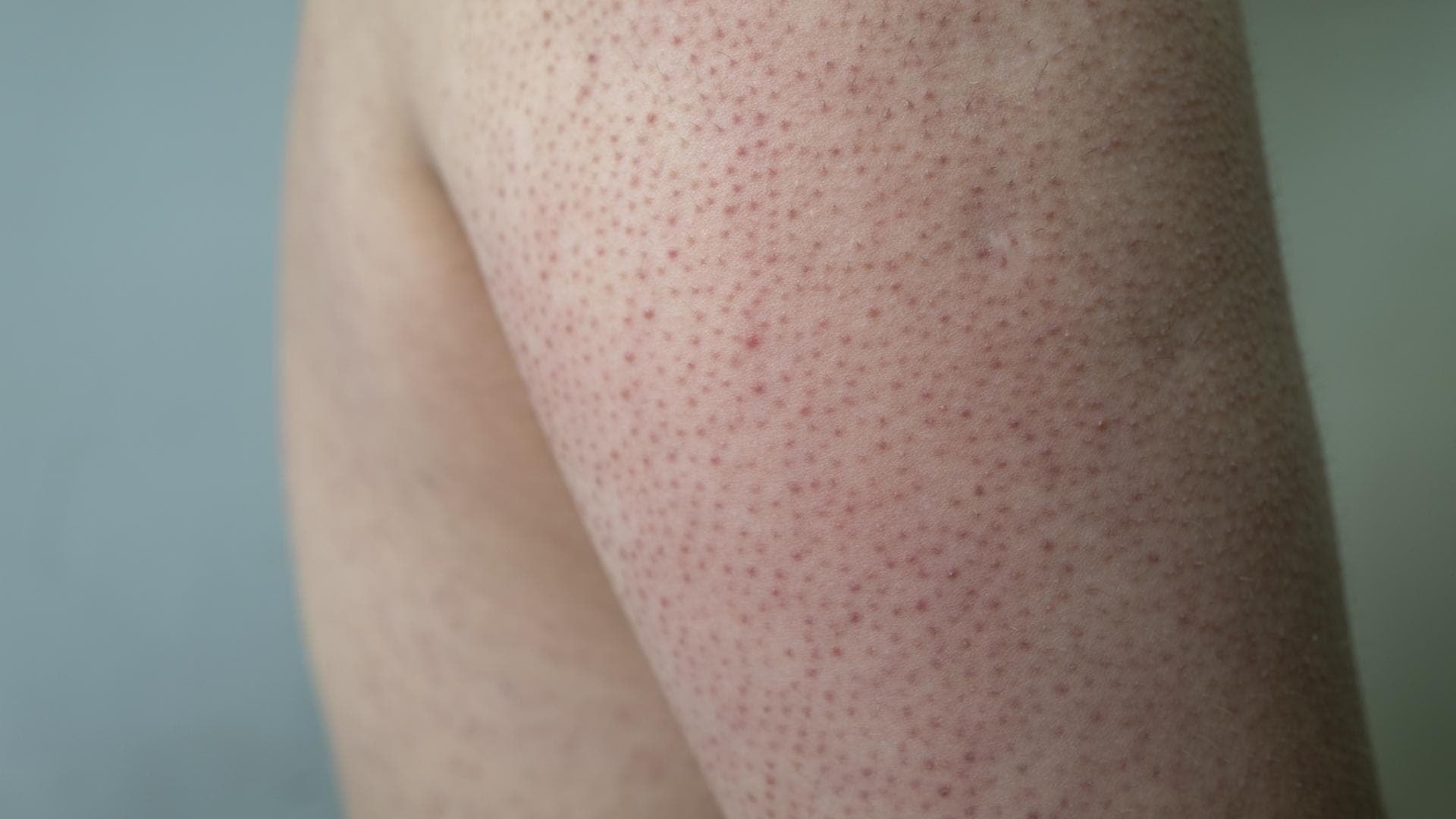 Keratosis pilaris