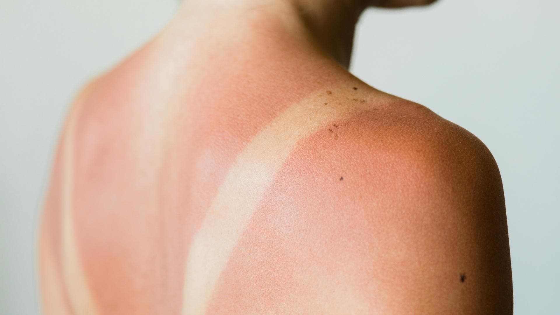 Frau mit Sonnenbrand