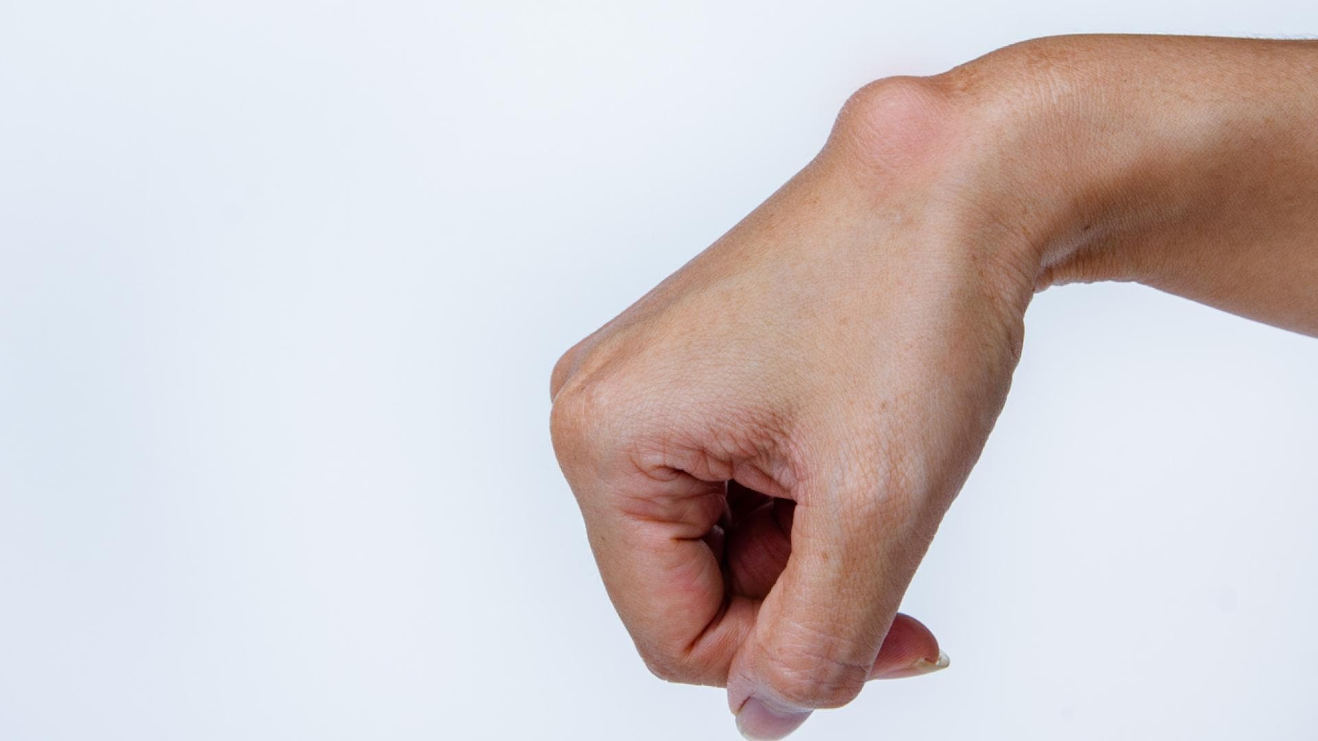 Ganglion am Handgelenk