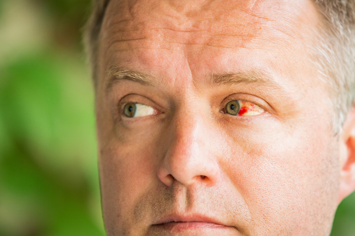 Geplatztes äderchen Im Auge Was Tun