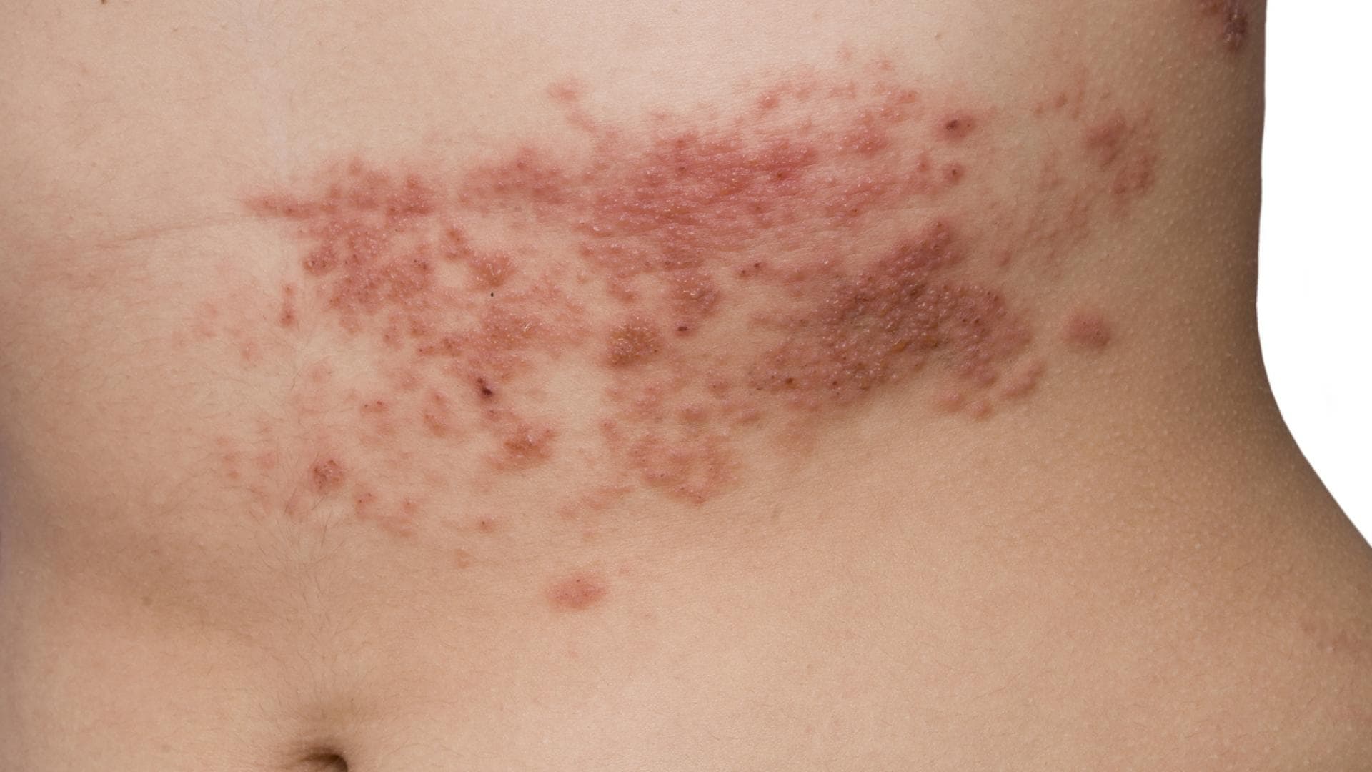 Gürtelrose mit typischem Hautausschlag am Torso.