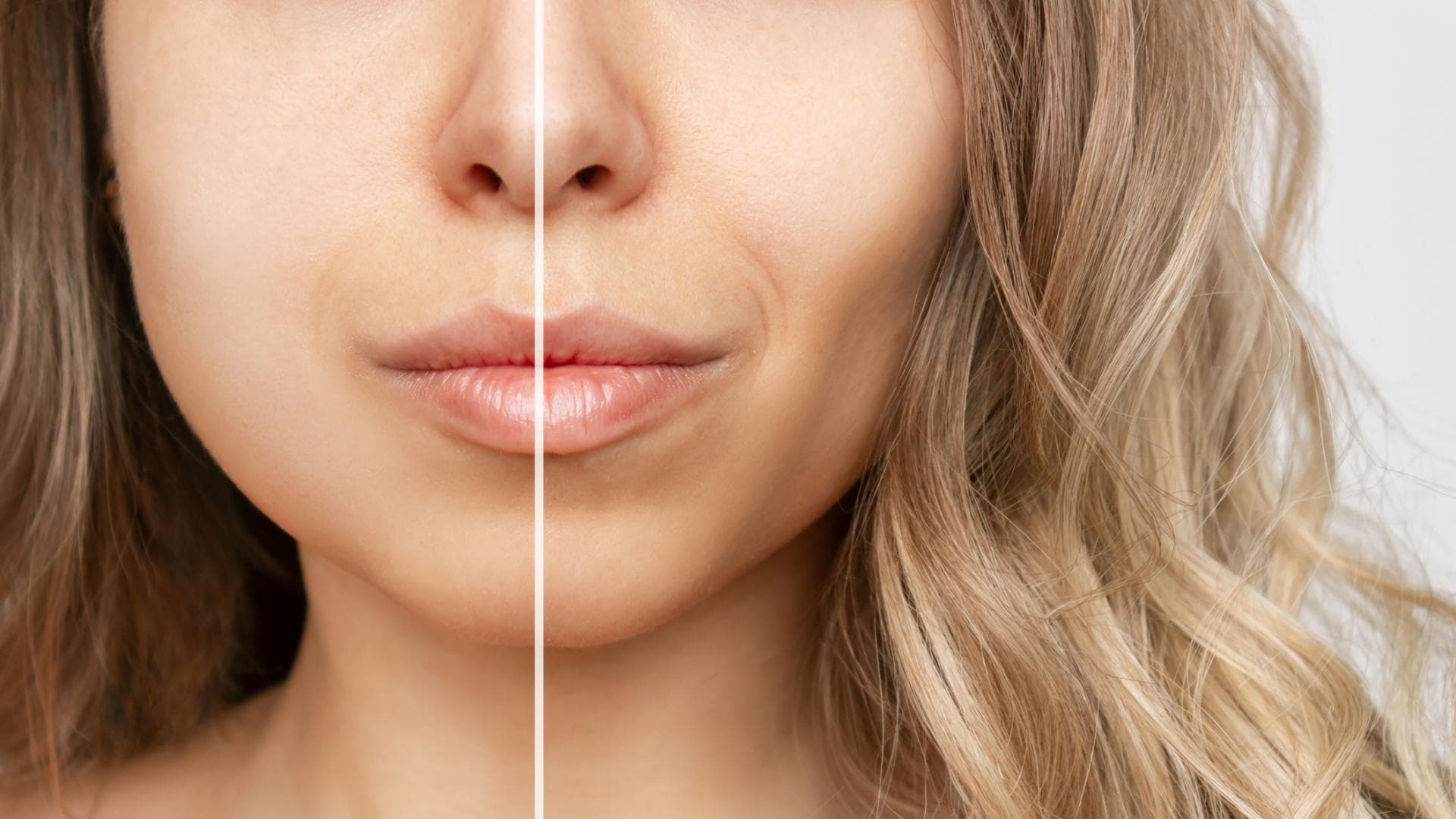 Buccal Fat Removal