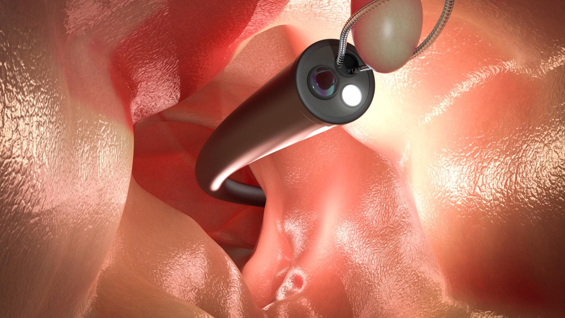 Polypen können mit speziellen Werkzeugen entfernt werden Animation eines Endoskops mit Schlaufe zur Entfernung eines Polypen