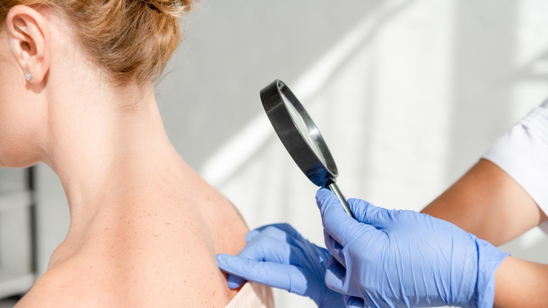 Die Krankenkassen übernehmen die Kosten für die Vorsorgeuntersuchung beim Hautarzt ab dem Alter von 35 Jahren Hautkrebs ist die häufigste Krebsart in Deutschland.
