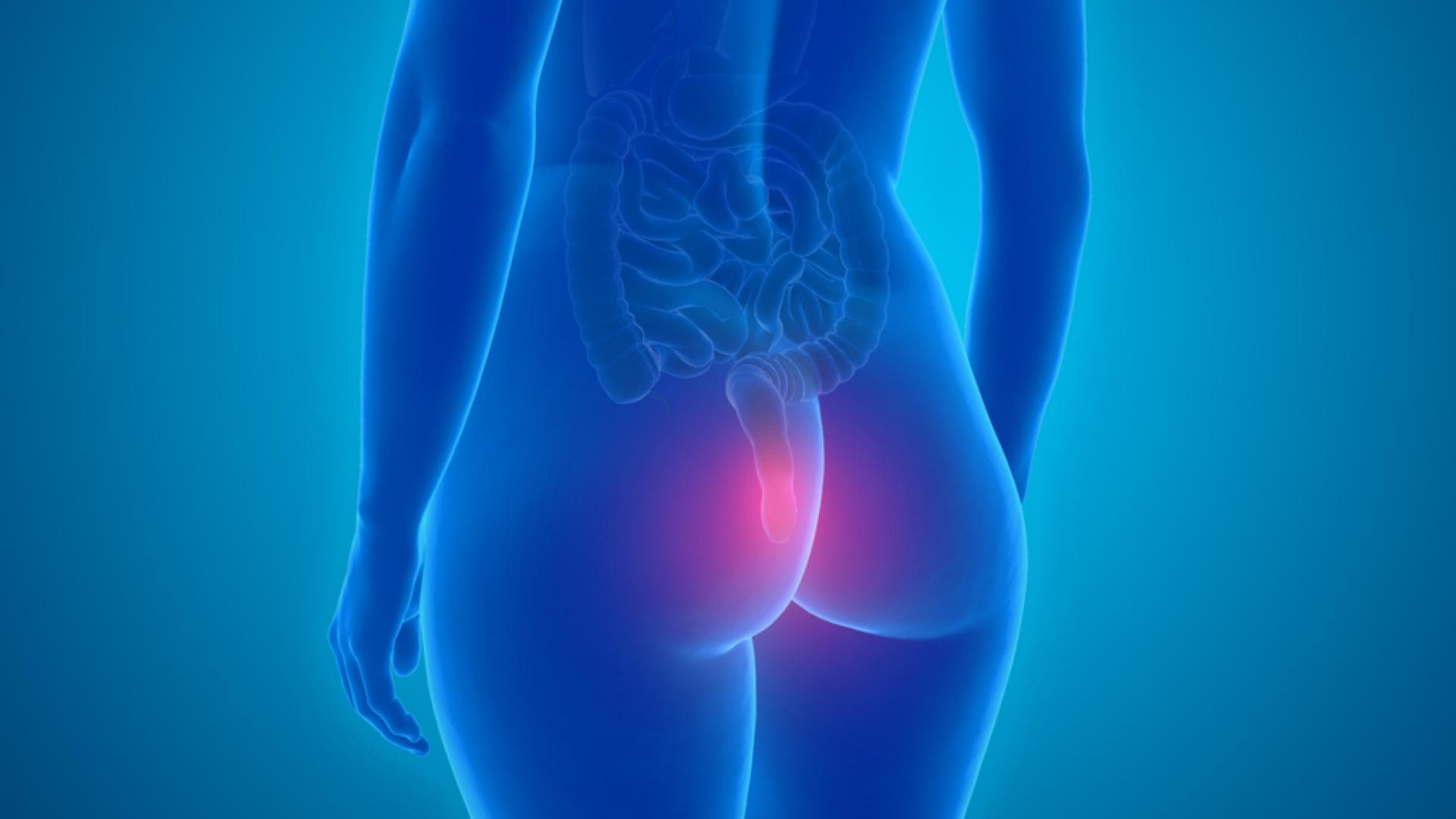 Durch intensives Pressen während des Stuhlgangs kann das Hämorrhoidalgewebe verletzt werden.