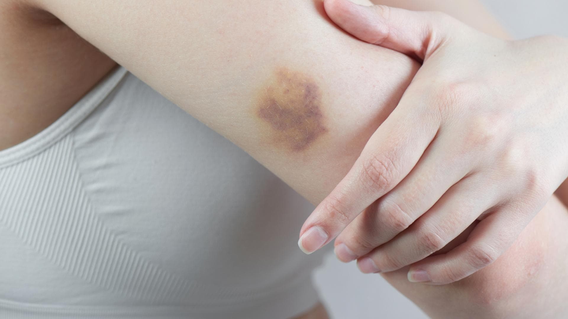 Blauer Fleck am Arm