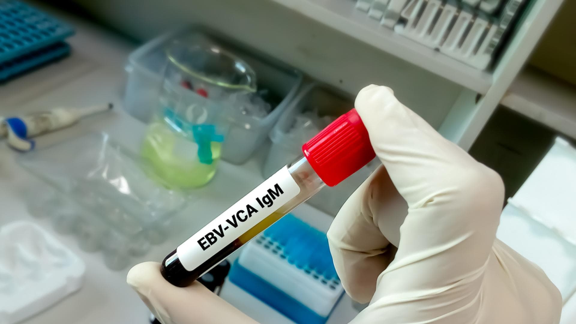 Laboruntersuchungen des EBV-Virus