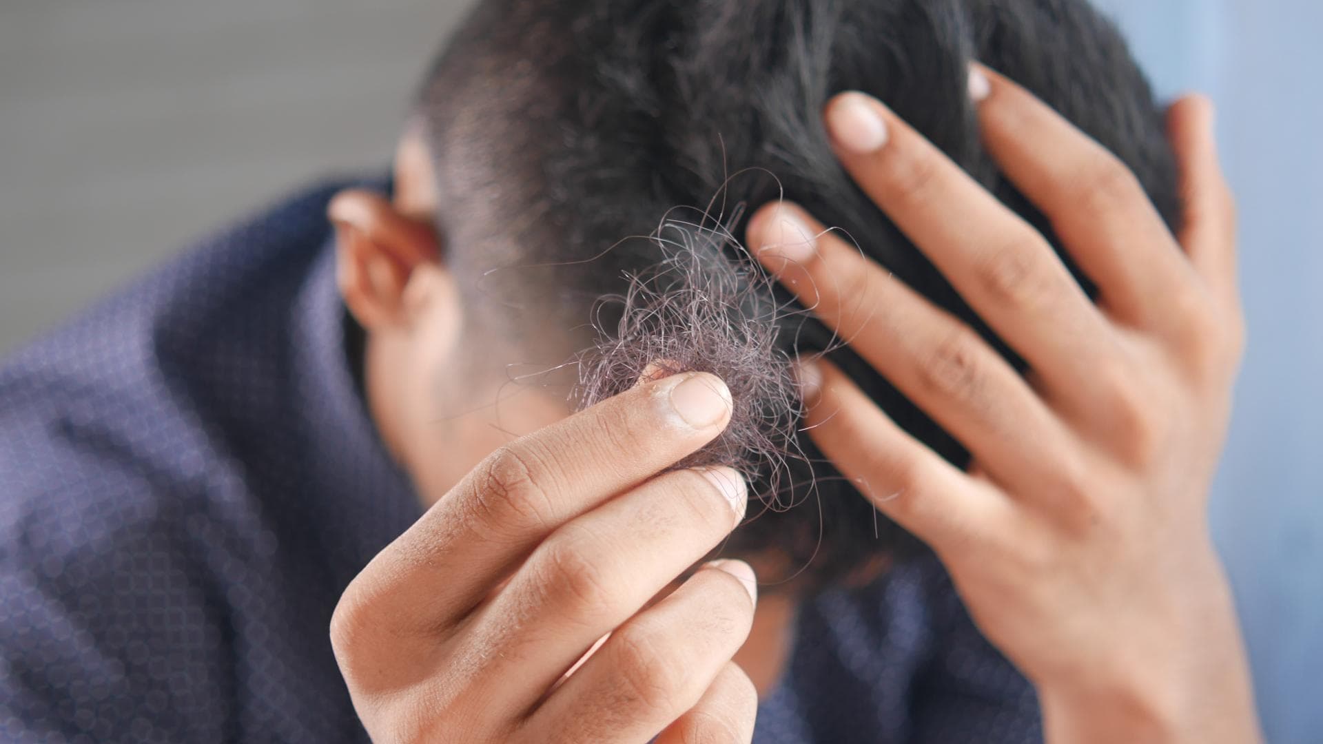 Mann hat Haarausfall Mann hat Haarausfall