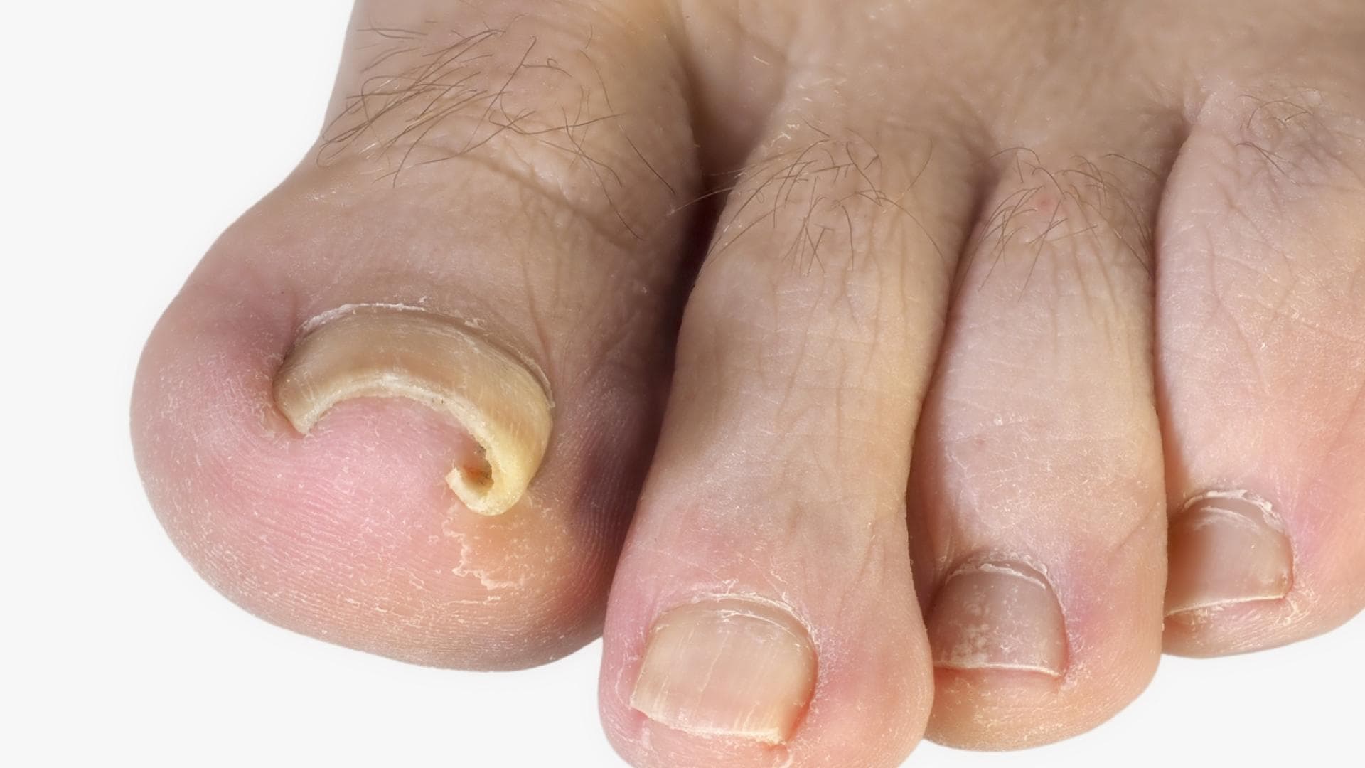 Rollnägel sind schmerzhafte Nagelveränderungen Rollnagel