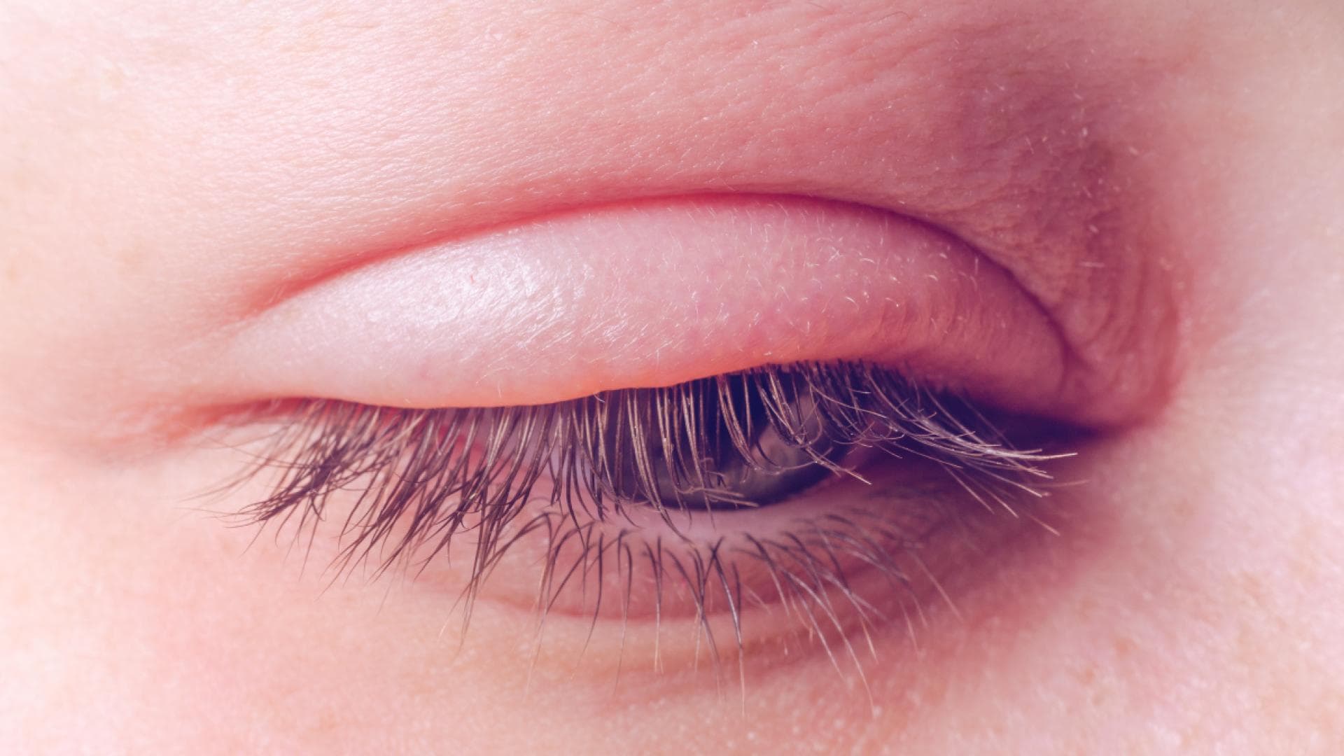 Infektion am Auge