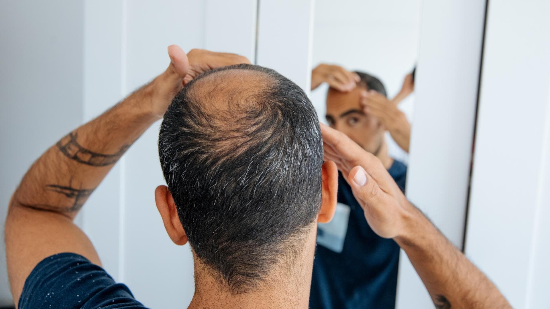 Haarausfall bei Männern hat verschiedene Ursachen