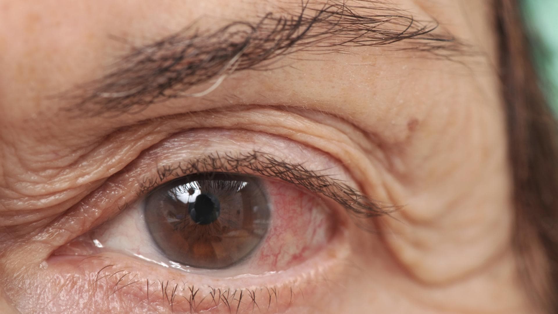 Auge eines älteren Mannes mit Bindehautentzündung zeigt Symptome wie Rötungen und Schwellungen