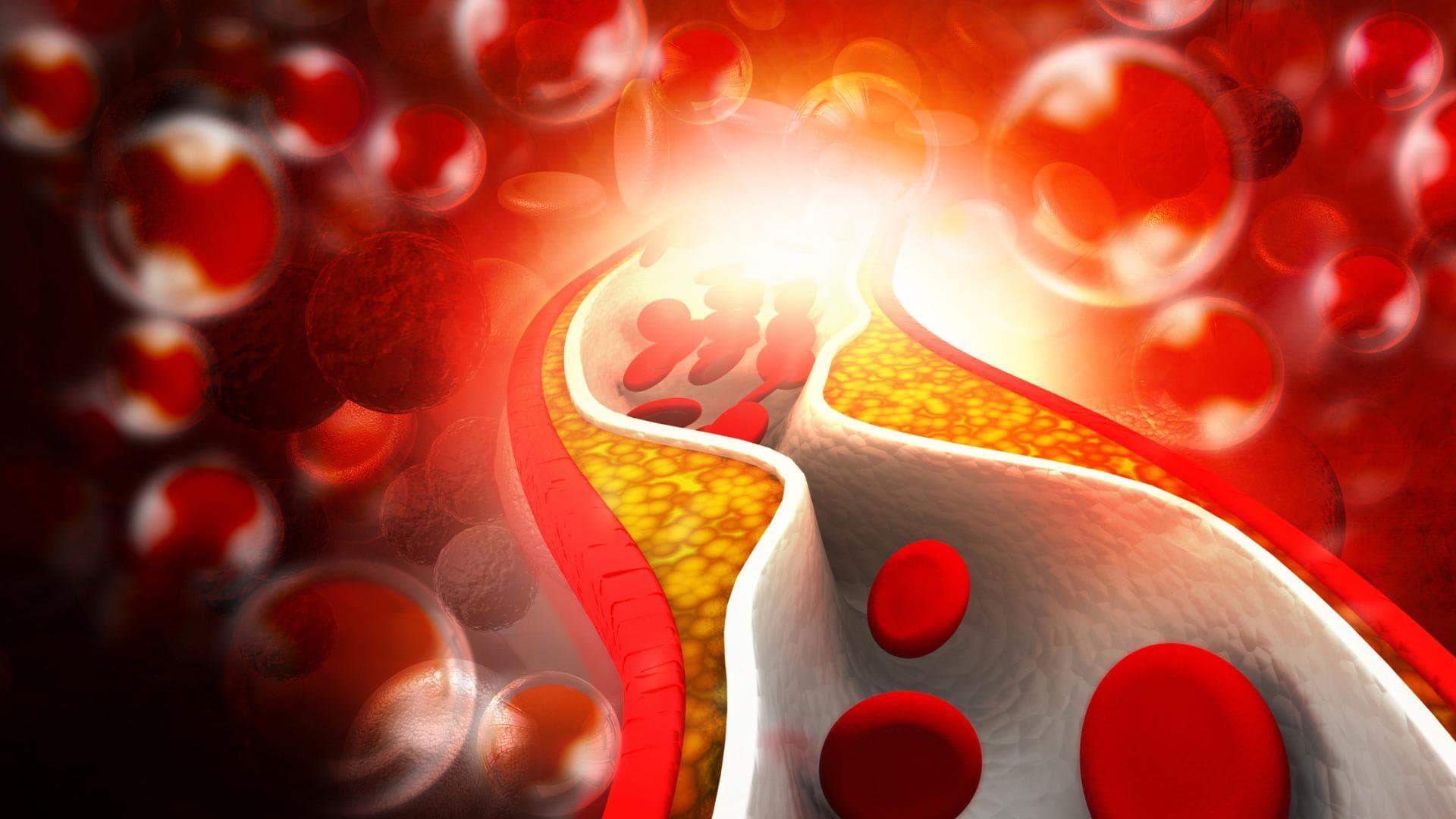 Verkalkte Arterie