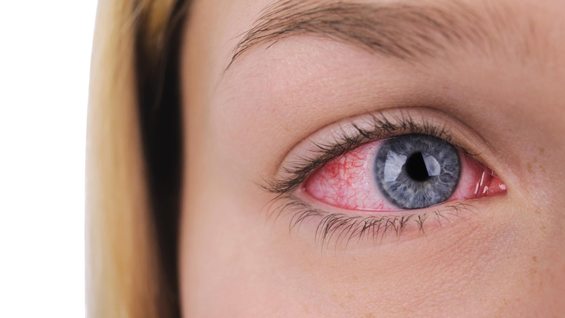 Thrombose im Auge