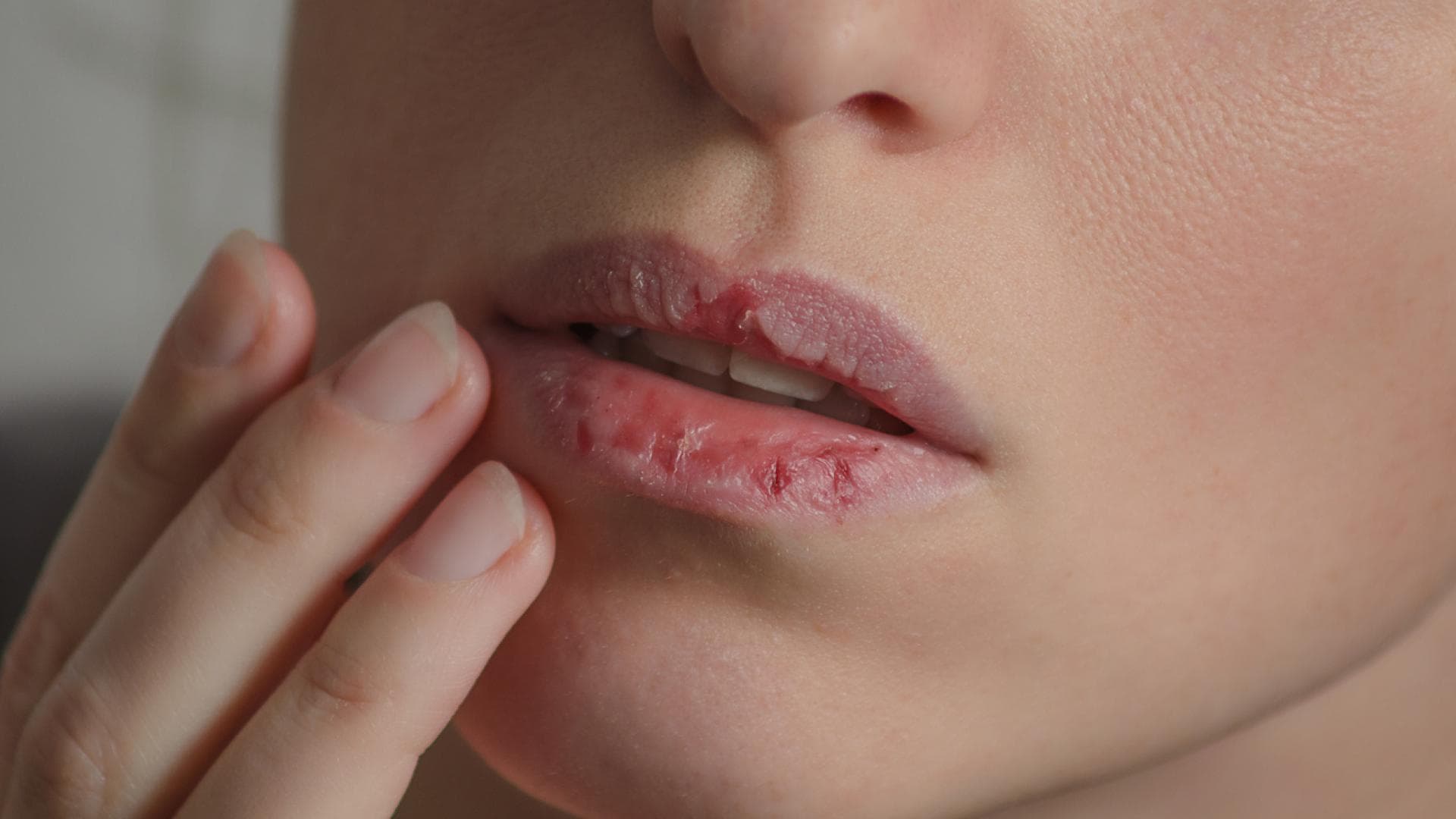 Lippenkrebs