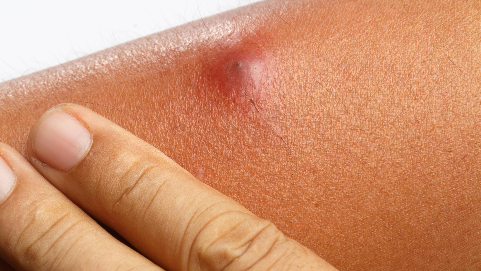 Ein Abszess auf einem Arm Ein Abszess auf einem Arm