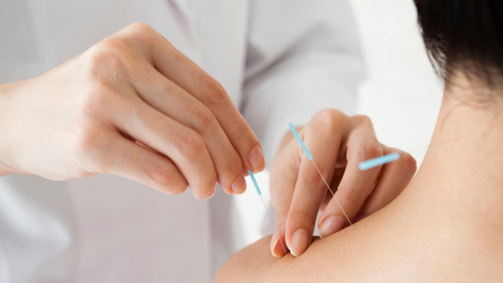 Wie wirkt Akupunktur? Ärztin steckt Akupunkturnadeln in Nacken einer Patientin