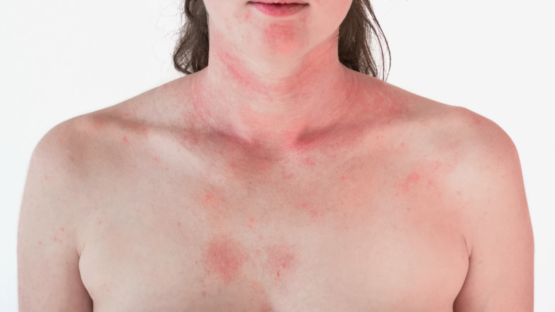 Dermatomyositis ist eine entzündliche Erkrankung der Haut und Muskeln. Dermatomyositis