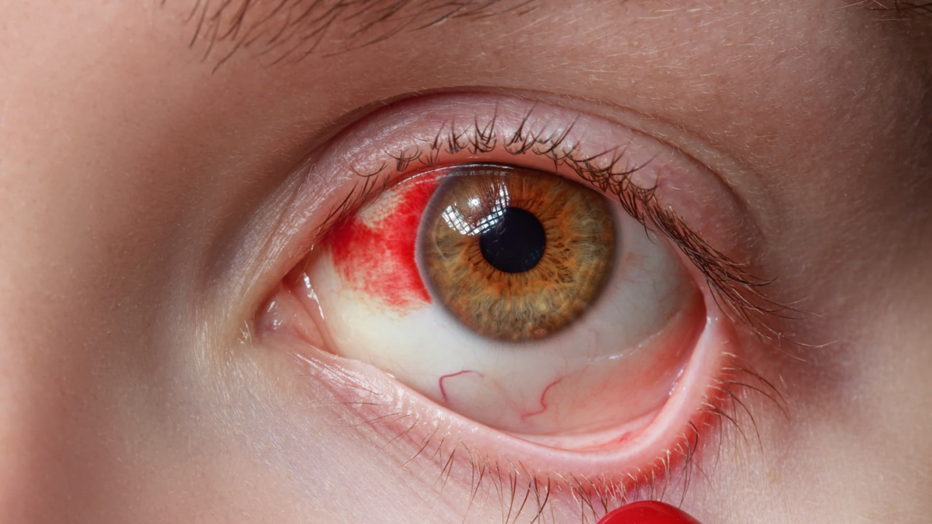 Eine Hornhautentzündung kann die Sehfähigkeit stark beeinträchtigen. Rotes Auge einer Frau