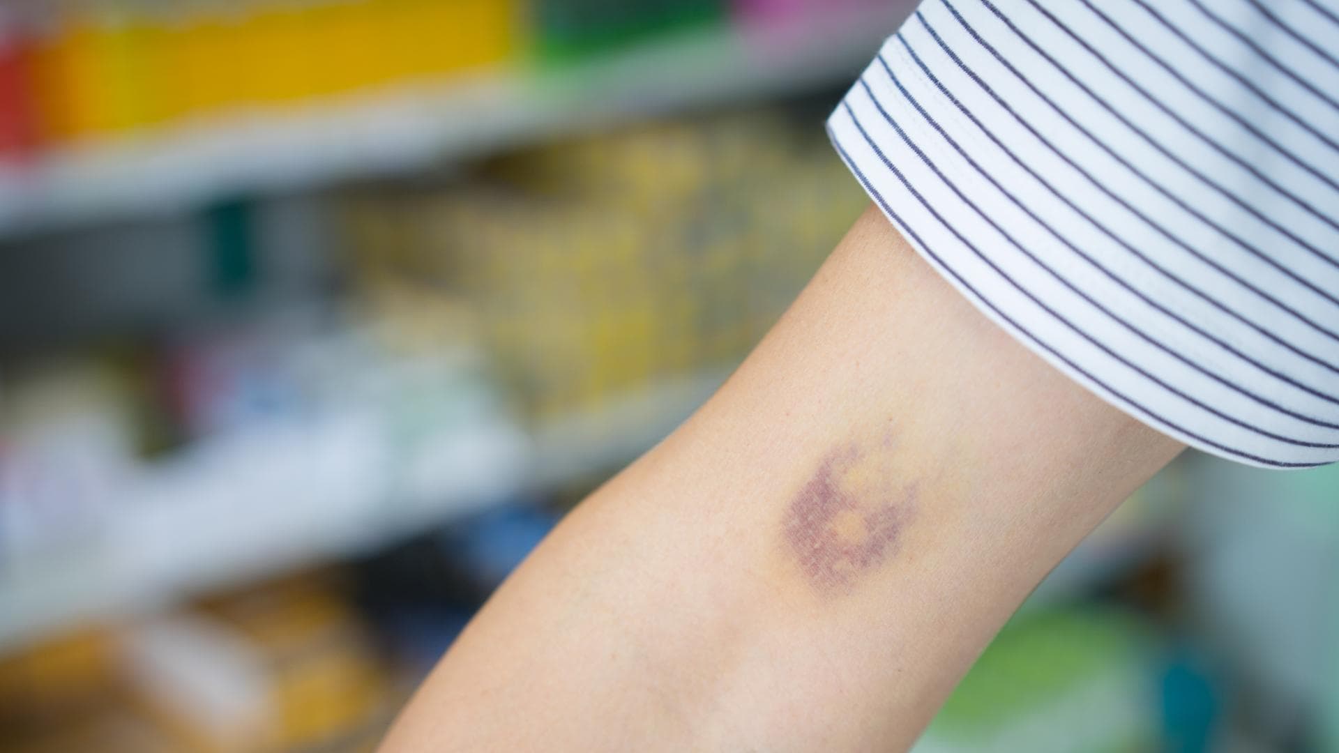 Kreisrunder Bluterguss auf einem Arm Kreisrunder Bluterguss auf einem Arm