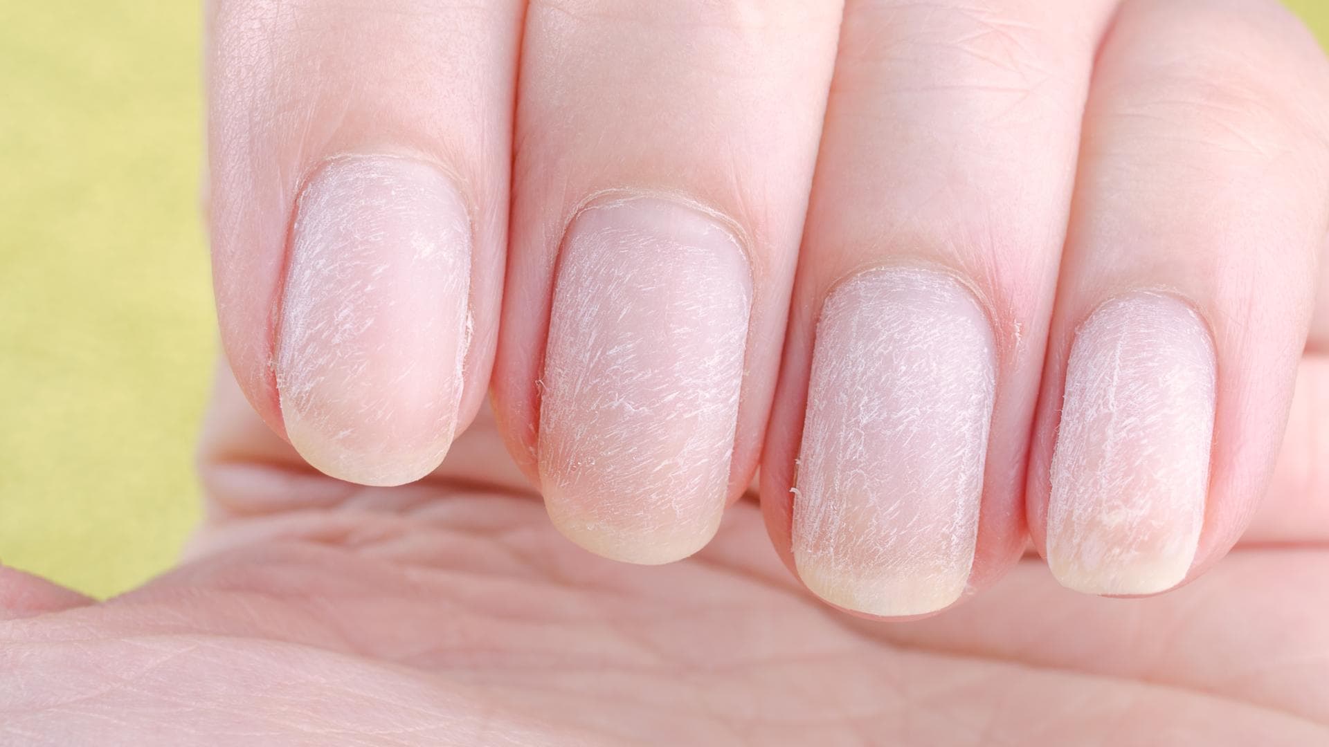 Wie Bekomme Ich Gelbe Fingernägel Wieder Weiß www.vital.de