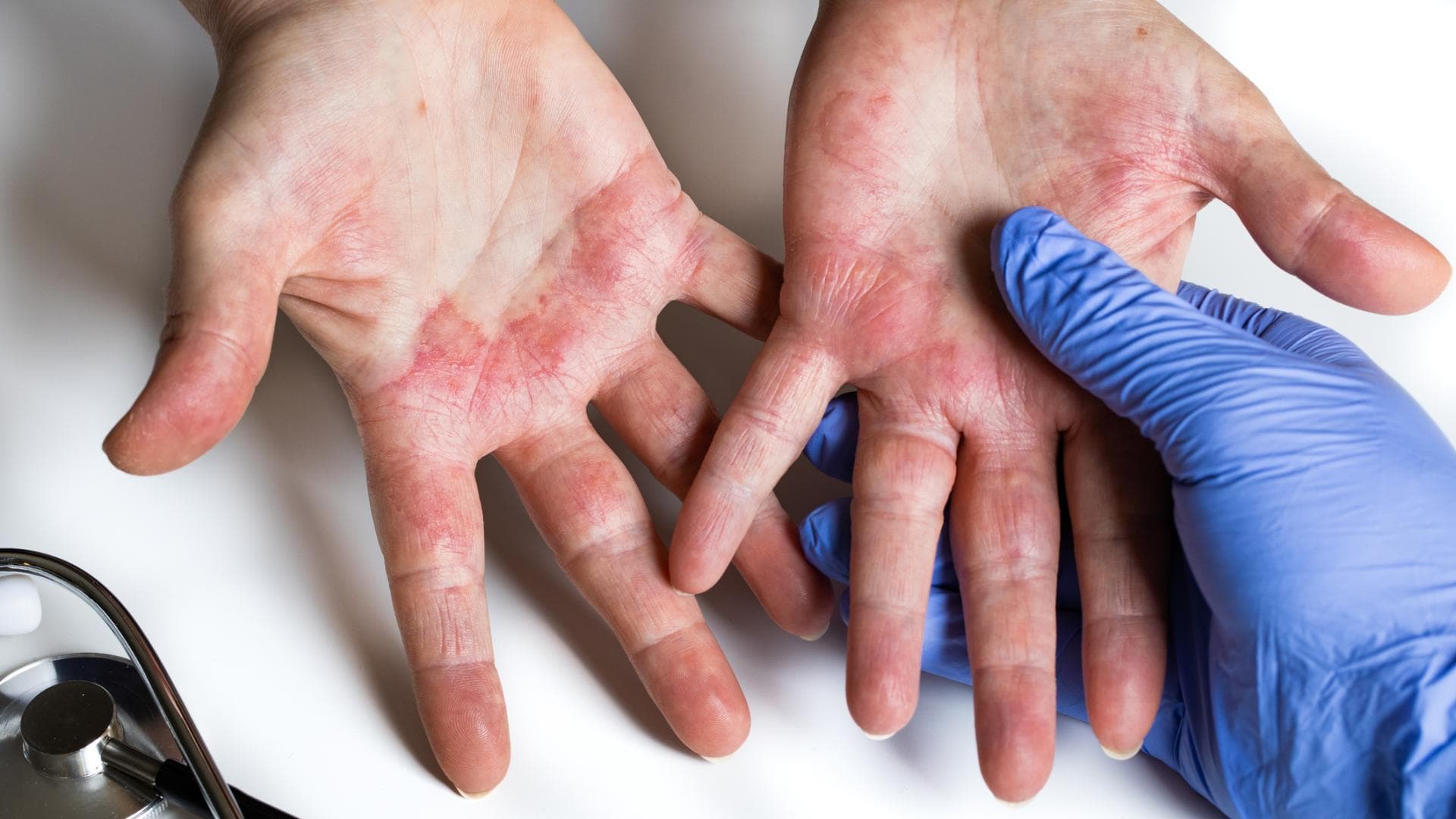 Eine Hand in Latexhandschuhen hält die Hände eines Patienten mit allergischem Ausschlag