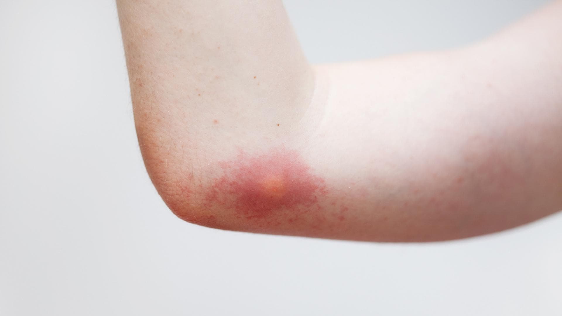 Wespenstich am Arm Wespenstich am Arm
