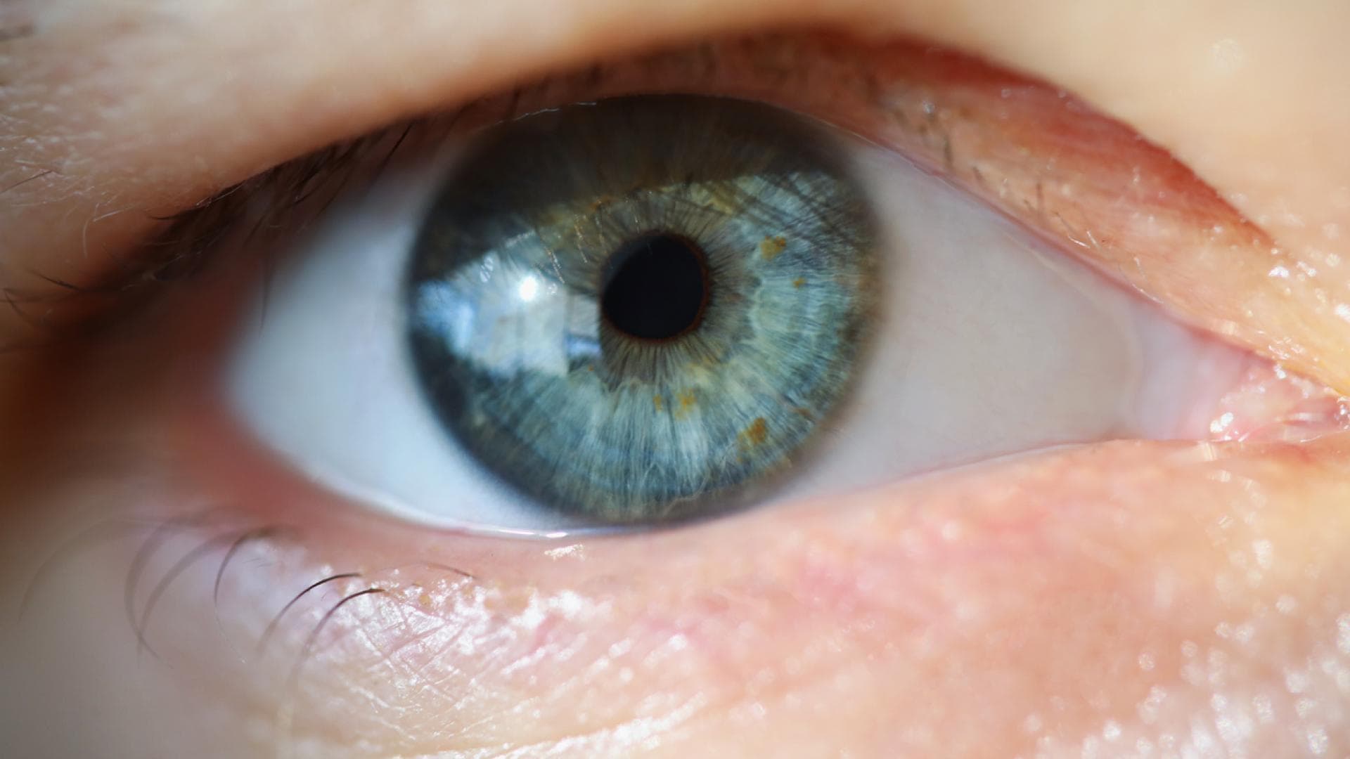 Nahaufnahme eines Auges, bei dem das Augenlid herunter hängt Nahaufnahme eines Auges, bei dem das Augenlid herunter hängt