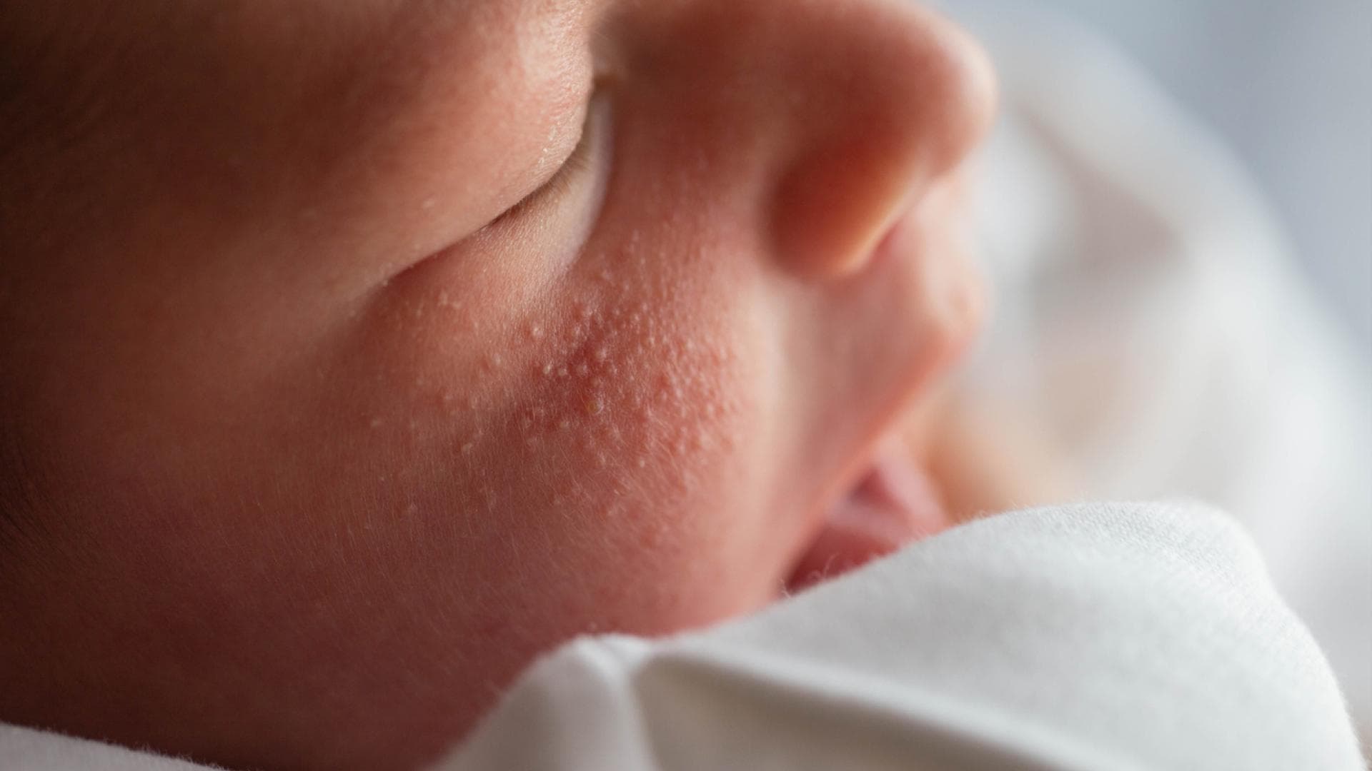 Hitzepickel bei Babys kommen sehr oft vor Nahaufnahme eines Hitzeausschlags auf der Wange eines Säuglings