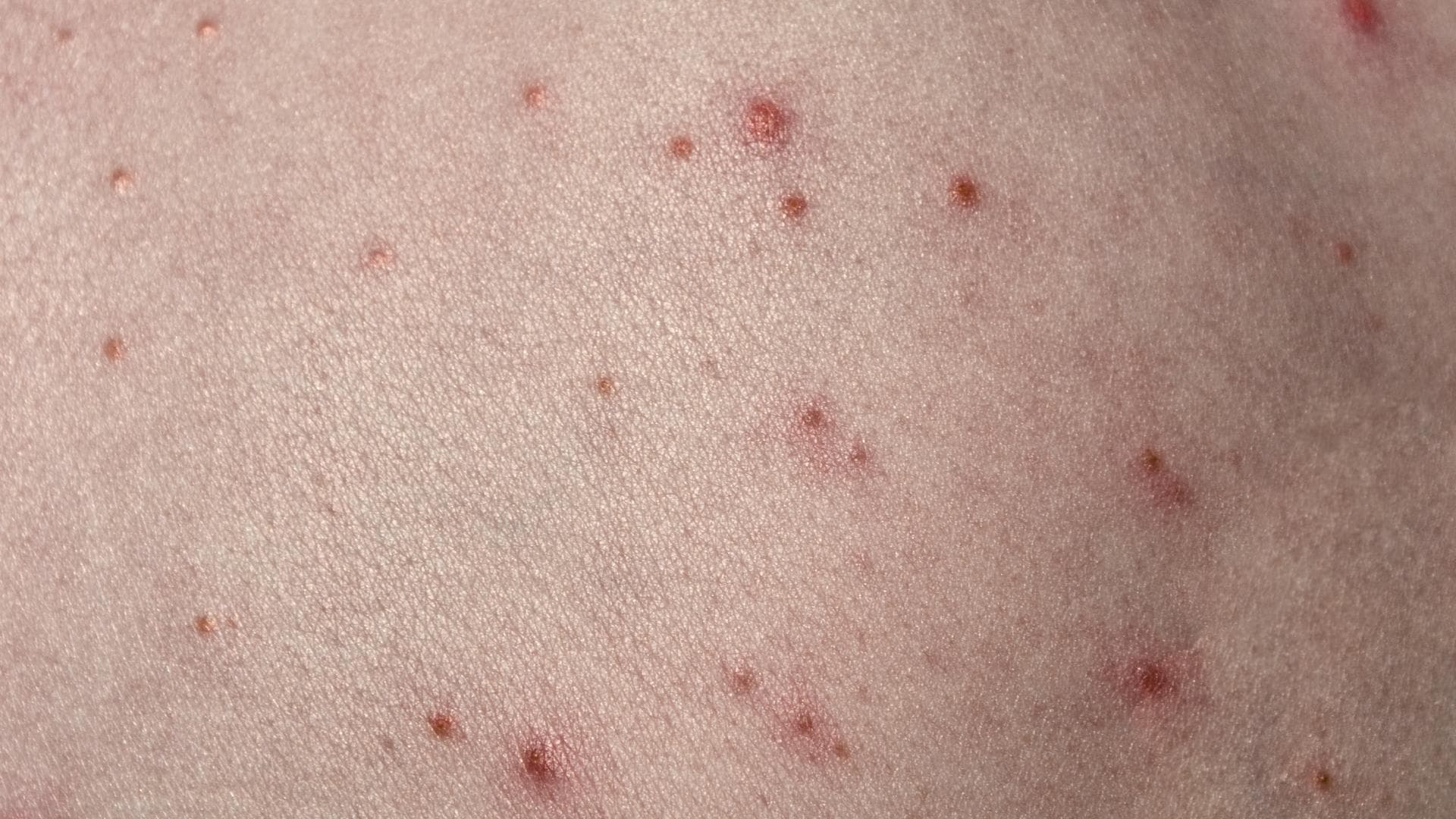Haut mit roten Pusteln darauf Haut mit roten Pusteln darauf