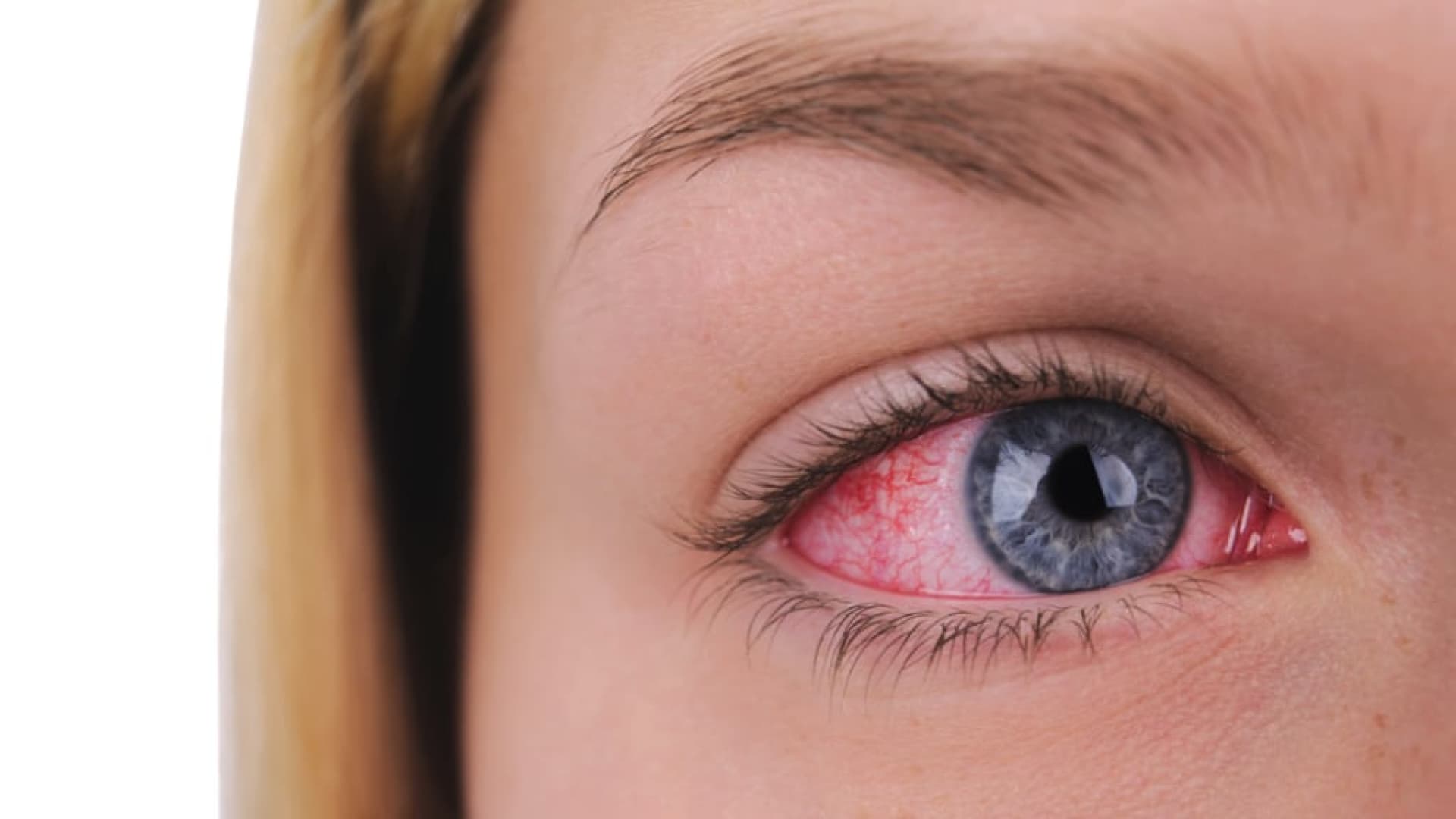 Rote-Augen-nach-dem-Schlafen-Normal-oder-Notfall-
